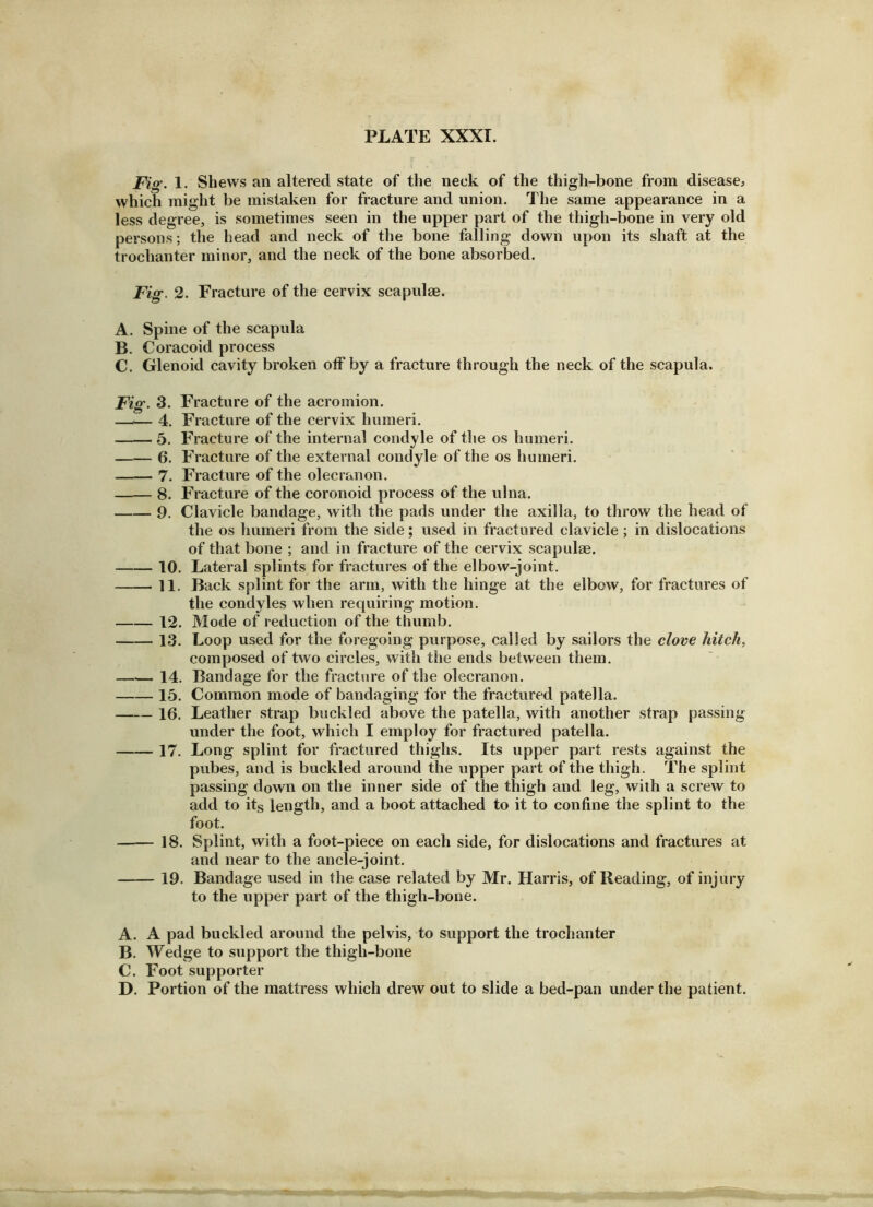 Fig. 1. Shews an altered state of the neck of the thigh-bone from disease^ which might be mistaken for fracture and union. The same appearance in a less degree, is sometimes seen in the upper part of the thigh-bone in very old persons; the head and neck of the bone falling down upon its shaft at the trochanter minor, and the neck of the bone absorbed. Fig. 2. Fracture of the cervix scapulae. A. Spine of the scapula B. Coracoid process C. Glenoid cavity broken off by a fracture through the neck of the scapula. Fig. 3. Fracture of the acromion. —— 4. Fracture of the cervix humeri. 5. Fracture of the internal condyle of the os humeri. 6. Fracture of the external condyle of the os humeri. 7. Fracture of the olecranon. 8. Fracture of the coronoid process of the ulna. 9. Clavicle bandage, with the pads under the axilla, to throw the head of the os humeri from the side; used in fractured clavicle; in dislocations of that bone ; and in fracture of the cervix scapulae. 10. Lateral splints for fractures of the elbow-joint. 11, Back splint for the arm, with the hinge at the elbow, for fractures of the condyles when requiring motion. 12. Mode of reduction of the thumb. 13. Loop used for the foregoing purpose, called by sailors the clove hitch, composed of two circles, with the ends between them. 14. Bandage for the fracture of the olecranon. 15. Common mode of bandaging for the fractured patella. 16. Leather strap buckled above the patella, with another strap passing under the foot, which I employ for fractured patella. 17. Long splint for fractured thighs. Its upper part rests against the pubes, and is buckled around the upper part of the thigh. The splint passing down on the inner side of the thigh and leg, with a screw to add to its length, and a boot attached to it to confine the splint to the foot. 18. Splint, with a foot-piece on each side, for dislocations and fractures at and near to the ancle-joint. 19. Bandage used in the case related by Mr. Harris, of Reading, of injury to the upper part of the thigh-bone. A. A pad buckled around the pelvis, to support the trochanter B. Wedge to support the thigh-bone C. Foot supporter D. Portion of the mattress which drew out to slide a bed-pan under the patient.