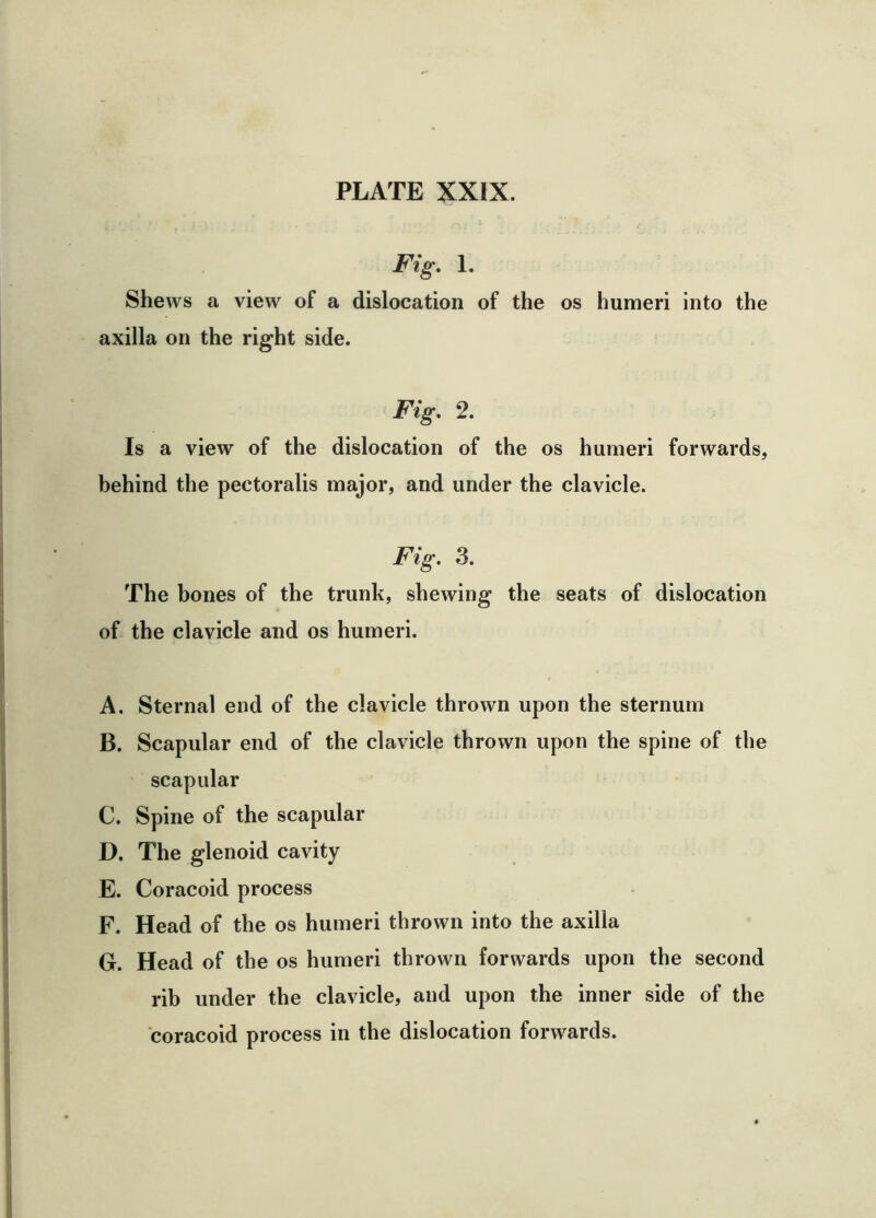 Fig, 1. Shews a view of a dislocation of the os humeri into the axilla on the right side. Fig, 2, Is a view of the dislocation of the os humeri forwards, behind the pectoralis major, and under the clavicle. Fig, 3, The bones of the trunk, shewing the seats of dislocation of the clavicle and os humeri. A. Sternal end of the clavicle thrown upon the sternum B. Scapular end of the clavicle thrown upon the spine of the ' scapular C. Spine of the scapular D. The glenoid cavity E. Coracoid process F. Head of the os humeri thrown into the axilla G. Head of the os humeri thrown forwards upon the second rib under the clavicle, and upon the inner side of the coracoid process in the dislocation forwards.