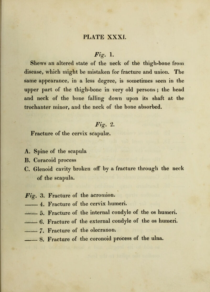 Fig. 1. Shews an altered state of the neck of the thigh-bone from disease, which might be mistaken for fracture and union. The same appearance, in a less degree, is sometimes seen in the upper part of the thigh-bone in very old persons ; the head and neck of the bone falling down upon its shaft at the trochanter minor, and the neck of the bone absorbed. Fig. 2. Fracture of the cervix scapulae. A. Spine of the scapula B. Coracoid process C. Glenoid cavity broken off by a fracture through the neck of the scapula. »> Fig. 3. Fracture of the acromion. 4. Fracture of the cervix humeri. 5, Fracture of the internal condyle of the os humeri. 6. Fracture of the external condyle of the os humeri. 7. Fracture of the olecranon.