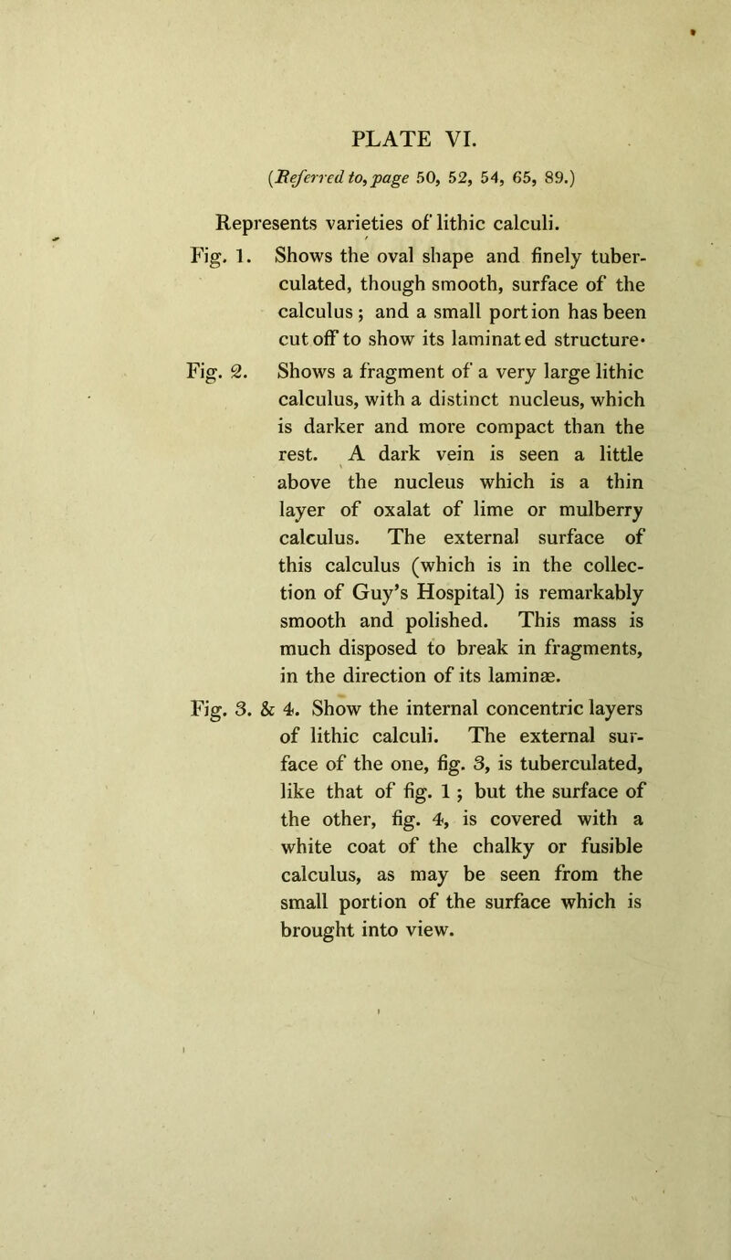 t PLATE VI. (Referred to, page 50, 52, 54, 65, 89.) Represents varieties oflithic calculi. Fig. 1. Shows the oval shape and finely tuber- culated, though smooth, surface of the calculus ; and a small portion has been cutoff to show its laminated structure- Fig. 2. Shows a fragment of a very large lithic calculus, with a distinct nucleus, which is darker and more compact than the rest. A dark vein is seen a little above the nucleus which is a thin layer of oxalat of lime or mulberry calculus. The external surface of this calculus (which is in the collec- tion of Guy’s Hospital) is remarkably smooth and polished. This mass is much disposed to break in fragments, in the direction of its laminae. Fig. 3. & 4. Show the internal concentric layers of lithic calculi. The external sur- face of the one, fig. 3, is tuberculated, like that of fig. 1 ; but the surface of the other, fig. 4, is covered with a white coat of the chalky or fusible calculus, as may be seen from the small portion of the surface which is brought into view.