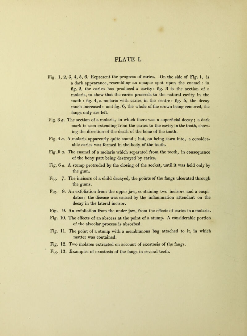 Fig, 1, 2, 3, 4, 5, 6. Represent the progress of caries. On the side of Fig. 1, is a dark appearance, resembling an opaque spot upon the enamel : in fig. 2, the caries has produced a cavity: fig. 3 is the section of a molaris, to show that the caries proceeds to the natural cavity in the tooth: fig. 4, a molaris with caries in the centre : fig. 5, the decay much increased : and fig. 6, the whole of the crown being removed, the fangs only are left. Fig. 3 a. The section of a molaris, in which there was a superficial decay; a dark mark is seen extending from the caries to the cavity in the tooth, show- ing the direction of the death of the bone of the tooth. Fig. 4 a. A molaris apparently quite sound; but, on being sawn into, a consider- able caries was formed in the body of the tooth. Fig. .5 a. The enamel of a molaris which separated from the tooth, in consequence of the bony part being destroyed by caries. Fig. 6 a. A stump protruded by the closing of the socket, until it was held only by the gum. Fig. 7- The incisors of a child decayed, the points of the fangs ulcerated through the gums. Fig. 8. An exfoliation from the upper jaw, containing two incisors and a cuspi- datus : the disease was caused by the inflammation attendant on the decay in the lateral incisor. Fig. 9. An exfoliation from the under jaw, from the effects of caries in a molaris. Fig. 10. The effects of an abscess at the point of a stump. A considerable portion of the alveolar process is absorbed. Fig. 11. The point of a stump with a membranous bag attached to it, in which matter was contained. Fig. 12. Two molares extracted on account of exostosis of the fangs. Fig. 13. Examples of exostosis of the fangs in several teeth.