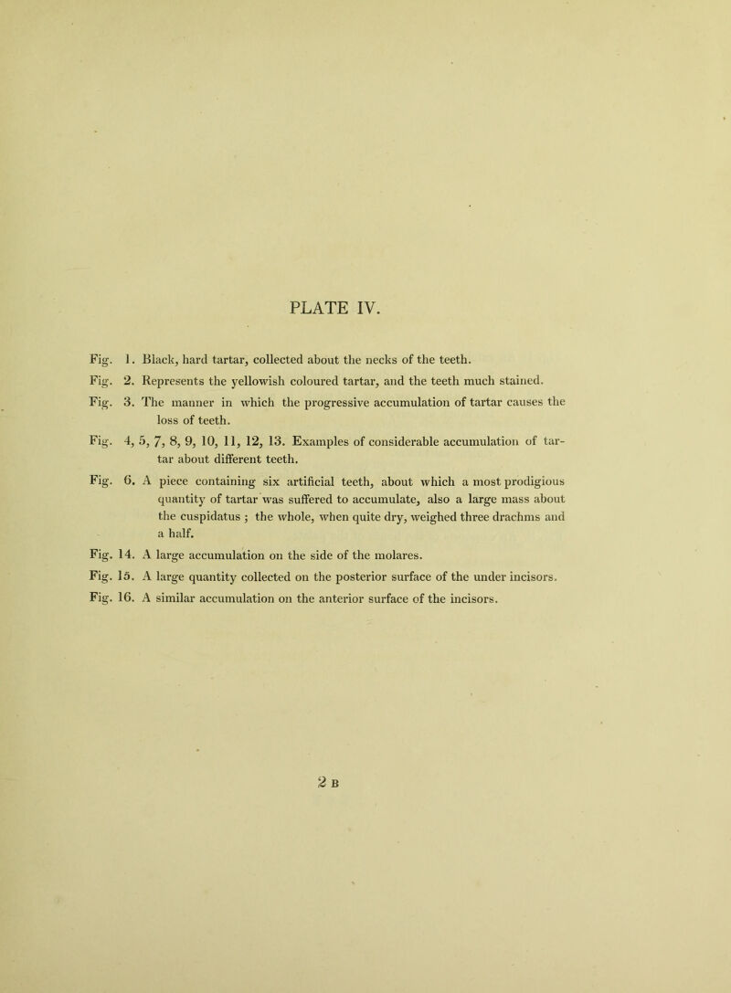 Fig. 1. Black, hard tartar, collected about the necks of the teeth. Fig. 2. Represents the yellowish coloured tartar, and the teeth much stained. Fig. 3. The manner in which the progressive accumulation of tartar causes the loss of teeth. Fig. 4, 5, 7, 8, 9, 10, 11, 12, 13. Examples of considerable accumulation of tar- tar about different teeth. Fig. 6. A piece containing six artificial teeth, about which a most prodigious quantity of tartar was suffered to accumulate, also a large mass about the cuspidatus ; the whole, when quite dry, weighed three drachms and a half. Fig. 14. A large accumulation on the side of the molares. Fig. lo. A large quantity collected on the posterior surface of the under incisors. Fig. 16. A similar accumulation on the anterior surface of the incisors.