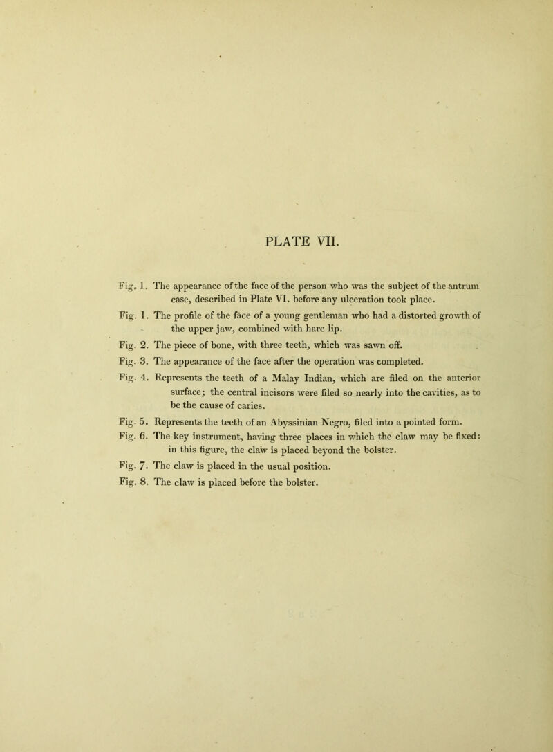 Fig. 1. The appearance of the face of the person who was the subject of the antrum case, described in Plate VI. before any ulceration took place. Fig. 1. The profile of the face of a young gentleman who had a distorted growth of the upper jaw, combined with hare lip. Fig. 2. The piece of bone, with three teeth, which was sawn off. Fig. 3. The appearance of the face after the operation was completed. Fig. 4. Represents the teeth of a Malay Indian, which are filed on the anterior surface; the central incisors were filed so nearly into the cavities, as to be the cause of caries. Fig. 5. Represents the teeth of an Abyssinian Negro, filed into a pointed form. Fig. 6. The key instrument, having three places in which the claw may be fixed: in this figure, the claw is placed beyond the bolster. Fig. / • The claw is placed in the usual position. Fig. 8. The claw is placed before the bolster.