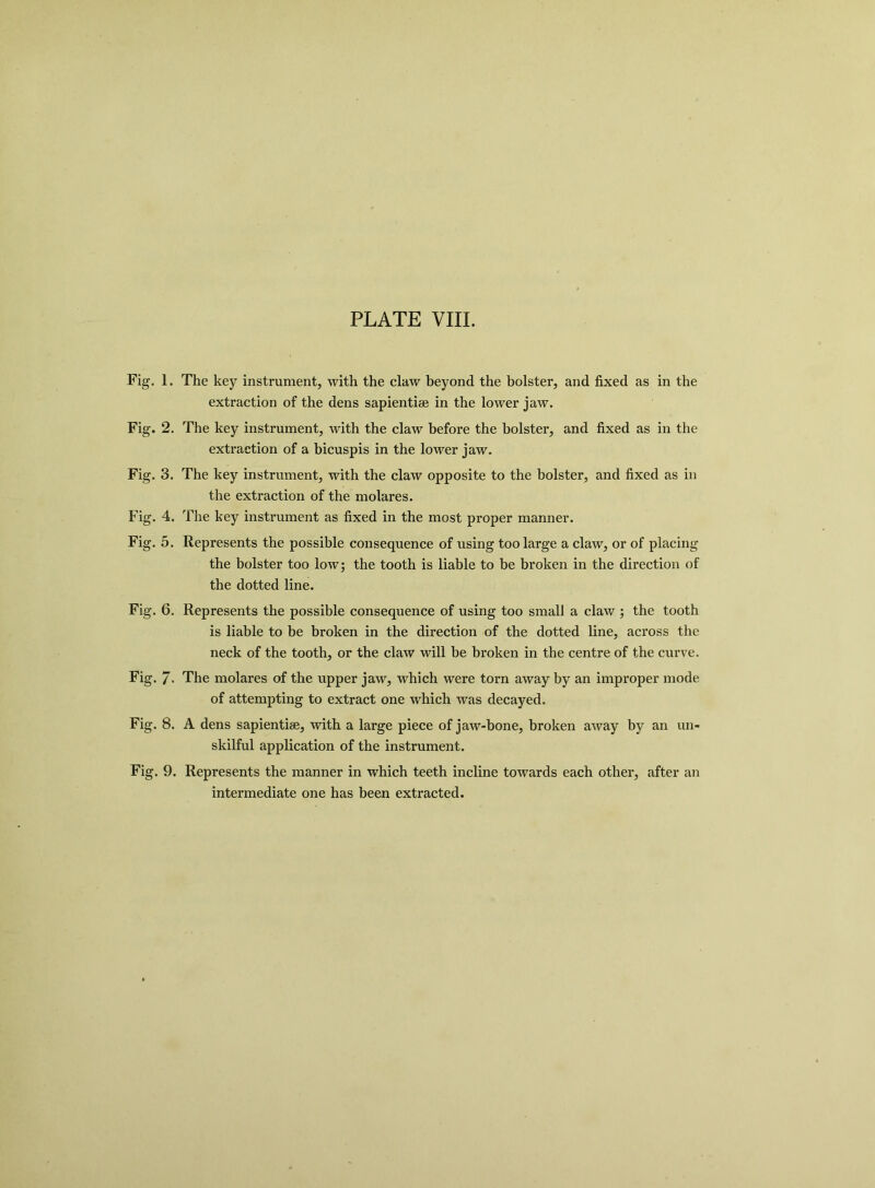 Fig. 1. Fig. 2. Fig. 3. Fig. 4. Fig. 5. Fig. 6. Fig- 7- Fig. 8. Fig. 9. The key instrument, with the claw beyond the bolster, and fixed as in the extraction of the dens sapientiee in the lower jaw. The key instrument, with the claw before the bolster, and fixed as in the extraction of a bicuspis in the lower jaw. The key instrument, with the claw opposite to the bolster, and fixed as in the extraction of the molares. The key instrument as fixed in the most proper manner. Represents the possible consequence of using too large a claw, or of placing the bolster too low; the tooth is liable to be broken in the direction of the dotted line. Represents the possible consequence of using too small a claw ; the tooth is liable to be broken in the direction of the dotted line, across the neck of the tooth, or the claw will be broken in the centre of the curve. The molares of the upper jaw, which were torn away by an improper mode of attempting to extract one which was decayed. A dens sapientiee, with a large piece of jaw-bone, broken away by an un- skilful application of the instrument. Represents the manner in which teeth incline towards each other, after an intermediate one has been extracted.
