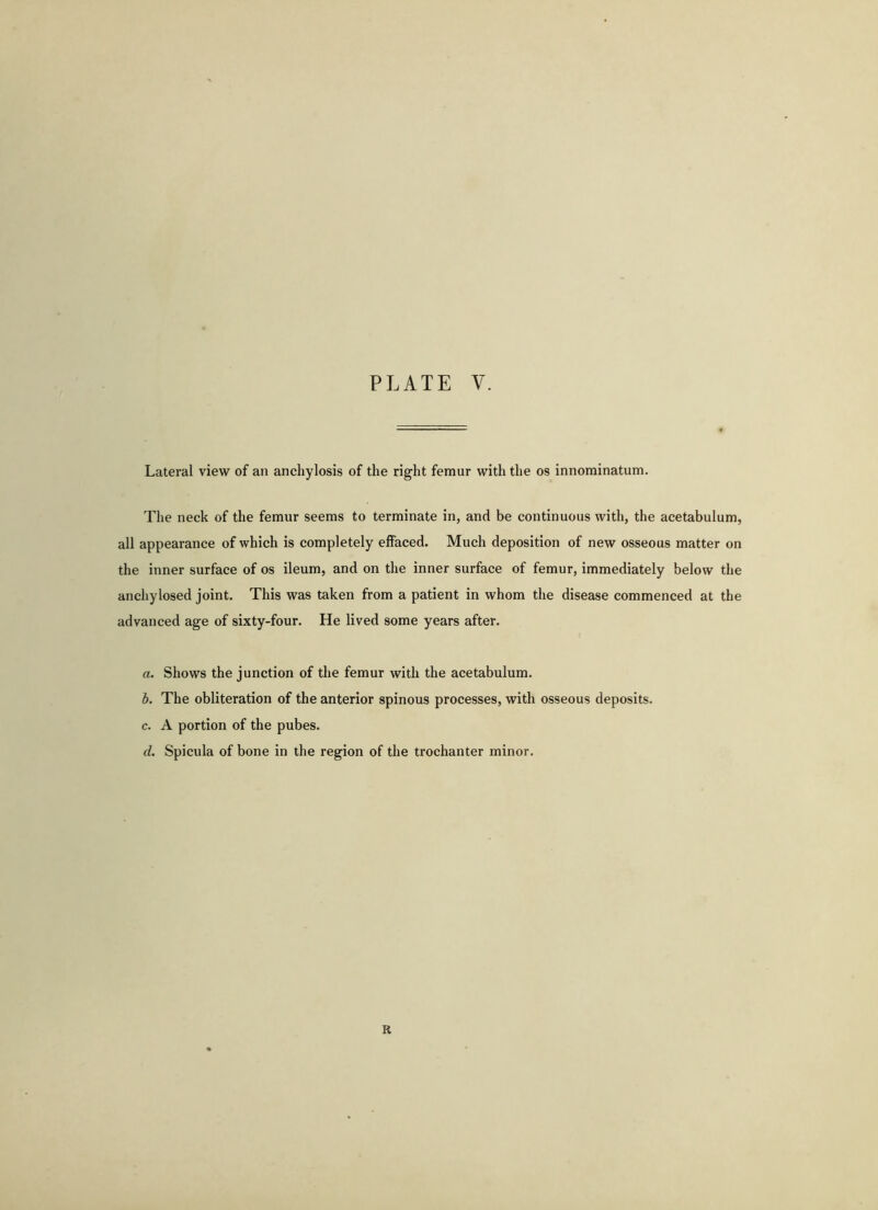 Lateral view of an anchylosis of the right femur with the os innominatum. The neck of the femur seems to terminate in, and be continuous with, the acetabulum, all appearance of which is completely effaced. Much deposition of new osseous matter on the inner surface of os ileum, and on the inner surface of femur, immediately below the anchylosed joint. This was taken from a patient in whom the disease commenced at the advanced age of sixty-four. He lived some years after. a. Shows the junction of the femur with the acetabulum. b. The obliteration of the anterior spinous processes, with osseous deposits. c. A portion of the pubes. d. Spicula of bone in the region of the trochanter minor. R