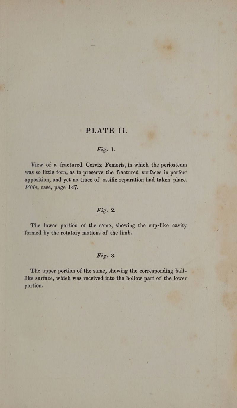 Fig. 1. View of a fractured Cervix Femoris, in which the periosteum was so little torn, as to preserve the fractured surfaces in perfect apposition, and yet no trace of ossific reparation had taken place. Vide, case, page 147. Fig. 2. The lower portion of the same, showing the cup-like cavity formed by the rotatory motions of the limb. Fig. 3. The upper portion of the same, showing the corresponding ball- like surface, which was received into the hollow part of the lower portion.