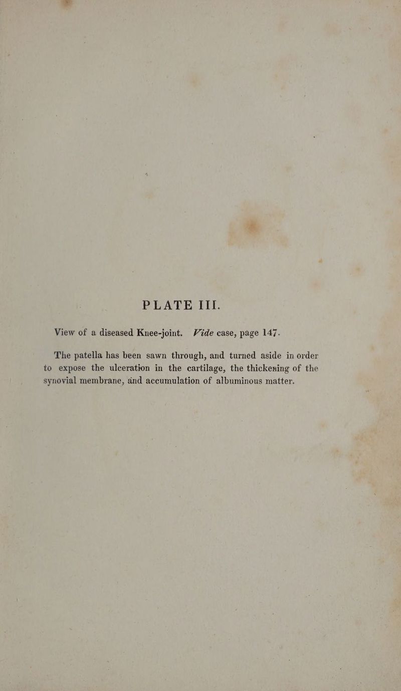 View of a diseased Knee-joint. Vide case, page 147. The patella has been sawn through, and turned aside in order to expose the ulceration in the cartilage, the thickening of the synovial membrane, and accumulation of albuminous matter.