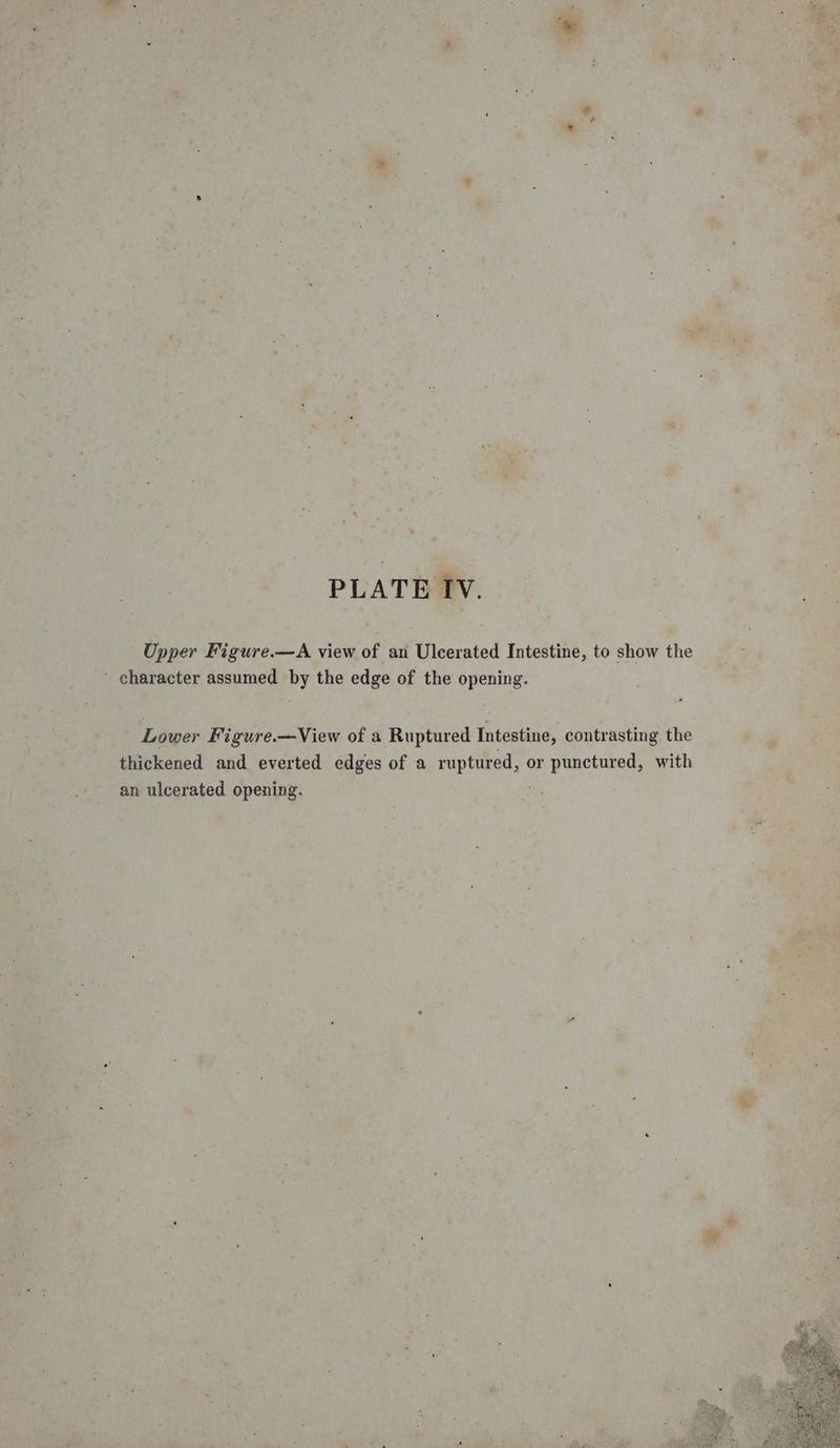 Upper Figure.—A view of an Ulcerated Intestine, to show the - character assumed by the edge of the opening. Lower Figure.—View of a Ruptured Intestine, contrasting the thickened and everted edges of a ruptured, ¢ or punctured, with an ulcerated opening.