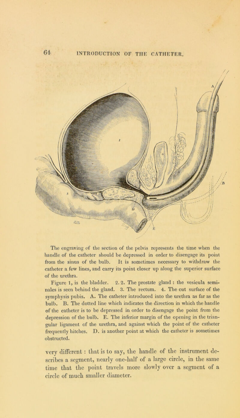 61 The engraving of the section of the pelvis represents the time when the handle of the catheter should be depressed in order to disengage its point from the sinus of the bulb. It is sometimes necessary to withdraw the catheter a few lines, and carry its point closer up along the superior surface of the urethra. Figure 1, is the bladder. 2.2. The prostate gland: the vesicula semi- nales is seen behind the gland. 3. The rectum. 4. The cut surface of the symphysis pubis. A. The catheter introduced into the urethra as far as the bulb. B. The dotted line which indicates the direction in which the handle of the catheter is to be depressed in order to disengage the point from the depression of the bulb. E. The inferior margin of the opening in the trian- gular ligament of the urethra, and against wdiich the point of the catheter frequently hitches. D. is another point at which the catheter is sometimes obstructed. very different : that is to say, the handle of the instrument de- scribes a segment, nearly one-half of a large circle, in the same time that the point travels more slowly over a segment of a circle of much smaller diameter.