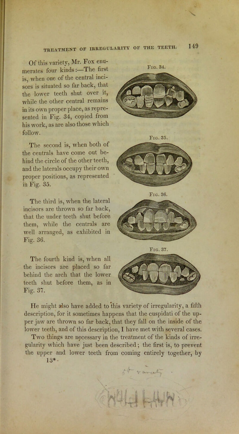 Of Ibis variety, Mr. Fox enu- merates four kinds:—The first is, when one of the central inci- sors is situated so far back, that the lower teeth shut over it, while the other central remains in its own proper place, as repre- sented in Fig. 34, copied from his work, as are also those which follow. The second is, when both of the centrals have come out be- hind the circle of the other teeth, and the laterals occupy their own proper positions, as represented in Fig. 35. The third is, when the lateral incisors are thrown so far back, that the under teeth shut before them, while the centrals are well arranged, as exhibited in Fig. 36. The fourth kind is, when all the incisors are placed so far behind the arch that the lower teeth shut before them, as in Fig. 37. Fig. 34. He might also have added to this variety of irregularity, a fifth description, for it sometimes happens that the cuspidati of the up- per jaw are thrown so far back, that they fall on the inside of the lower teeth, and of this description, I have met with several cases. Two things are necessary in the treatment of the kinds of irre- gularity which have just been described; the first is, to prevent the upper and lower teeth from coming entirely together, by 13* ■