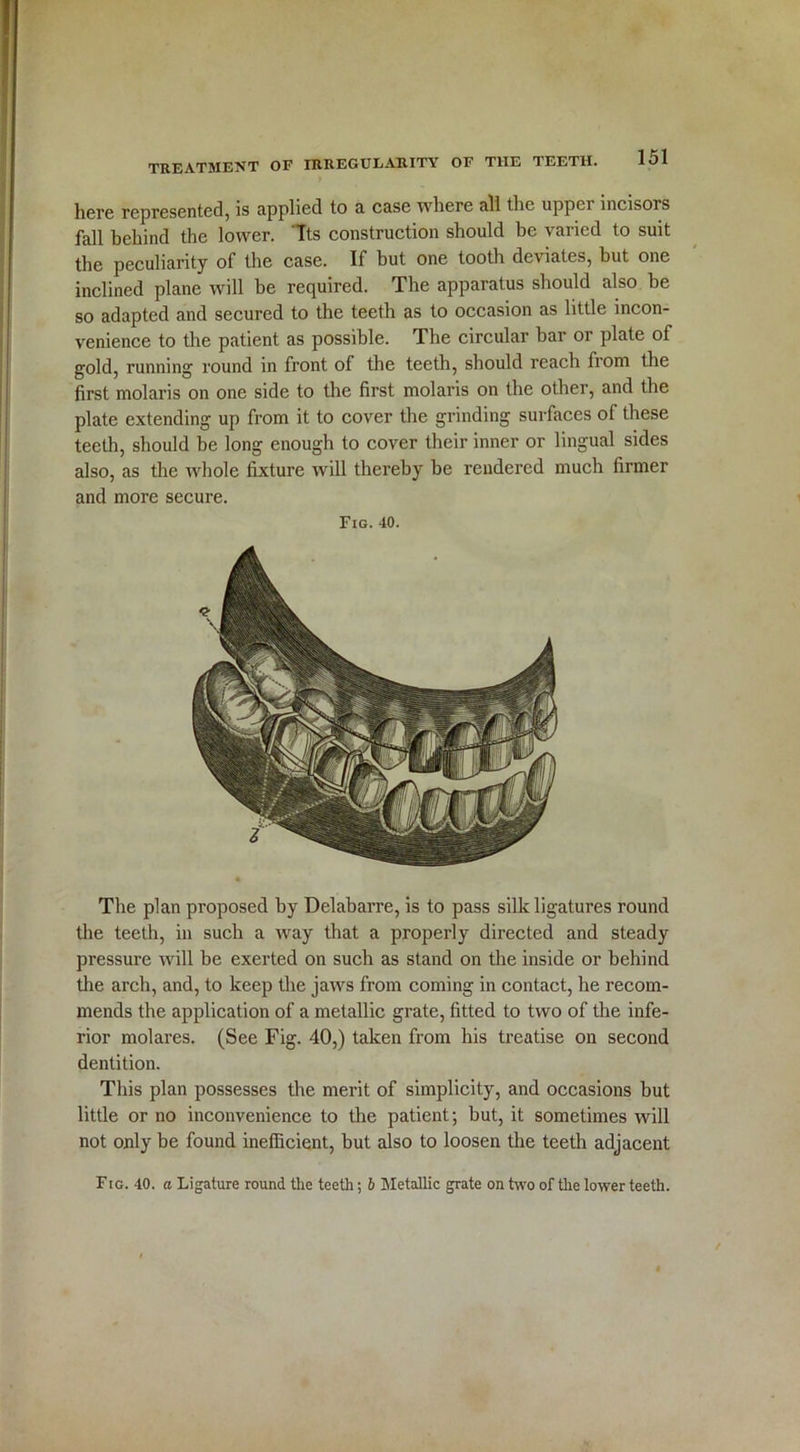 here represented, is applied to a case where all the upper incisors fall behind the lower. Its construction should be varied to suit the peculiarity of the case. If hut one tooth deviates, but one inclined plane will be required. The apparatus should also he so adapted and secured to the teeth as to occasion as little incon- venience to the patient as possible. The circular bar or plate of gold, running round in front of the teeth, should reach from the first molaris on one side to the first molaris on the other, and the plate extending up from it to cover the grinding surfaces of these teeth, should be long enough to cover their inner or lingual sides also, as the whole fixture will thereby be rendered much firmer and more secure. Fig. 40. The plan proposed by Delabarre, is to pass silk ligatures round the teeth, in such a way that a properly directed and steady pressure will be exerted on such as stand on the inside or behind the arch, and, to keep the jaws from coming in contact, he recom- mends the application of a metallic grate, fitted to two of the infe- rior molares. (See Fig. 40,) taken from his treatise on second dentition. This plan possesses the merit of simplicity, and occasions but little or no inconvenience to the patient-, but, it sometimes will not only be found inefficient, but also to loosen the teeth adjacent Fig. 40. a Ligature round tlie teeth; b Metallic grate on two of the lower teeth.