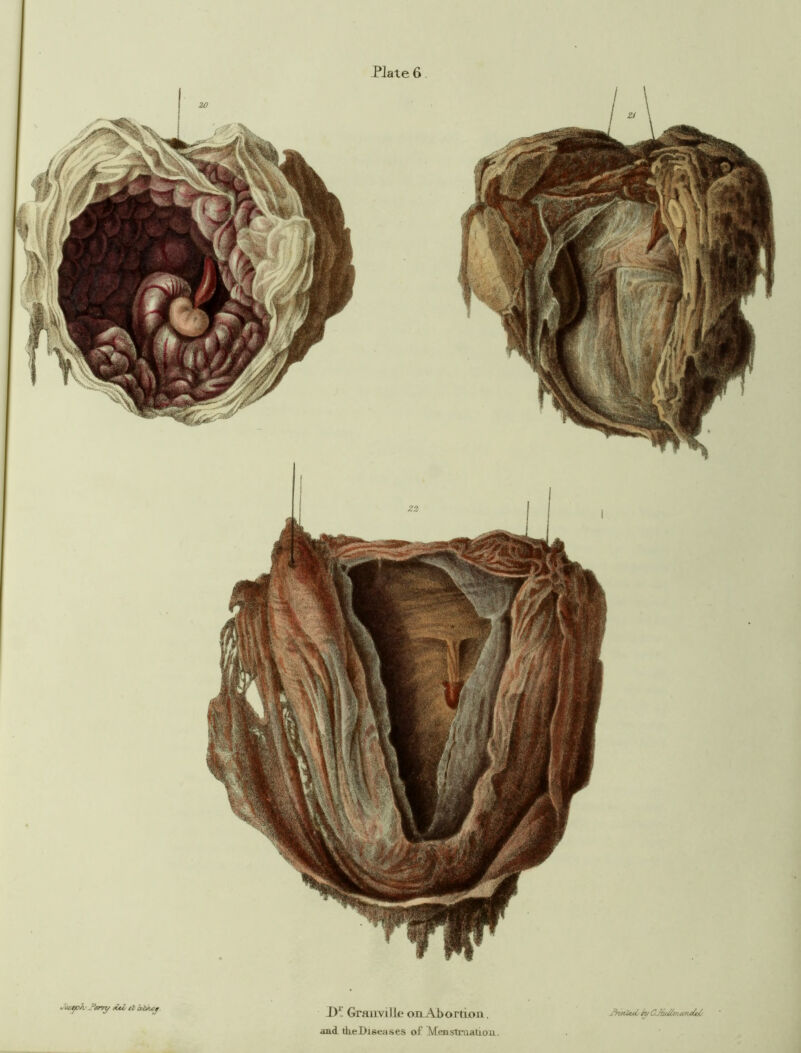 i)r Grau vilLc* on Abortion. and tiieDiseases of Menstniali.o'ii. o'iAseph' y^ny del el h&toj Jh/Ueel in/ C. Jtudm ancle//