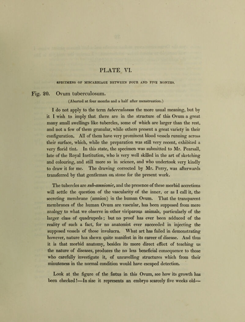 SPECIMENS OF MISCARRIAGE BETWEEN FOUR AND FIVE MONTHS. Fig. 20. Ovum tuberculosum. ' o (Aborted at four months and a half after menstruation.) I do not apply to the term tuberculosum the more usual meaning, but by it I wish to imply that there are in the structure of this Ovum a great many small swellings like tubercles, some of which are larger than the rest, and not a few of them granular, while others present a great variety in their configuration. All of them have very prominent blood vessels running across their surface, which, while the preparation was still very recent, exhibited a very florid tint. In this state, the specimen was submitted to Mr. Pearsall, late of the Royal Institution, who is very well skilled in the art of sketching and colouring, and still more so in science, and who undertook very kindly to draw it for me. The drawing corrected by Mr. Perry, was afterwards transferred by that gentleman oa stone for the present work. The tubercles are sub-amnionic, and the presence of these morbid accretions will settle the question of the vascularity of the inner, or as I call it, the secreting membrane (amnion) in the human Ovum. That the transparent membranes of the human Ovum are vascular, has been supposed from mere analogy to what we observe in other viviparous animals, particularly of the larger class of quadrupeds; but no proof has ever been adduced of the reality of such a fact, for no anatomist ever succeeded in injecting the supposed vessels of those involucra. What art has failed in demonstrating however, nature hag shewn quite manifest in its career of disease. And thus it is that morbid anatomy, besides its more direct effect of teaching us the nature of diseases, produces the no less beneficial consequence to those who carefully investigate it, of unravelling structures which from their minuteness in the normal condition would have escaped detection. Look at the figure of the foetus in this Ovum, see how its growth has been checked!—In size it represents an embryo scarcely five weeks old—