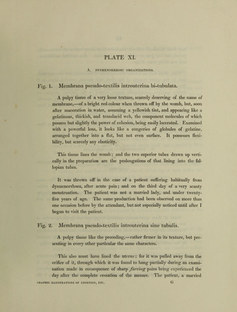 A. DYSMENORRHOIC ORGANIZATIONS. Fig. 1. Membrana pseudo-textilis introuterina bi-tubulata. A pulpy tissue of a very loose texture, scarcely deserving of the name of membrane,—of a bright red colour when thrown off by the womb, but, soon after maceration in water, assuming a yellowish tint, and appearing like a gelatinous, thickish, and translucid web, the component molecules of which possess but slightly the power of cohesion, being easily lacerated. Examined with a powerful lens, it looks like a congeries of globules of gelatine, arranged together into a flat, but not even surface. It possesses flexi- bility, but scarcely any elasticity. This tissue lines the womb; and the two superior tubes drawn up verti- cally in the preparation are the prolongations of that lining into the fal- lopian tubes. It was thrown off in the case of a patient suffering habitually from dysmenorrhoea, after acute pain; and on the third day of a very scanty menstruation. The patient was not a married lady, and under twenty- five years of age. The same production had been observed on more than one occasion before by the attendant, but not especially noticed until after I began to visit the patient. Fig. 2. Membrana pseudo-textilis introuterina sine tubulis. A pulpy tissue like the preceding,—rather firmer in its texture, but pre- senting in every other particular the same characters. This also must have lined the uterus; for it was pulled away from the orifice of it, through which it was found to hang partially during an exami- nation made in consequence of sharp forcing pains being experienced the day after the complete cessation of the menses. The patient, a married G GRAPHIC ILLUSTRATIONS OF ABORTION, ETC.