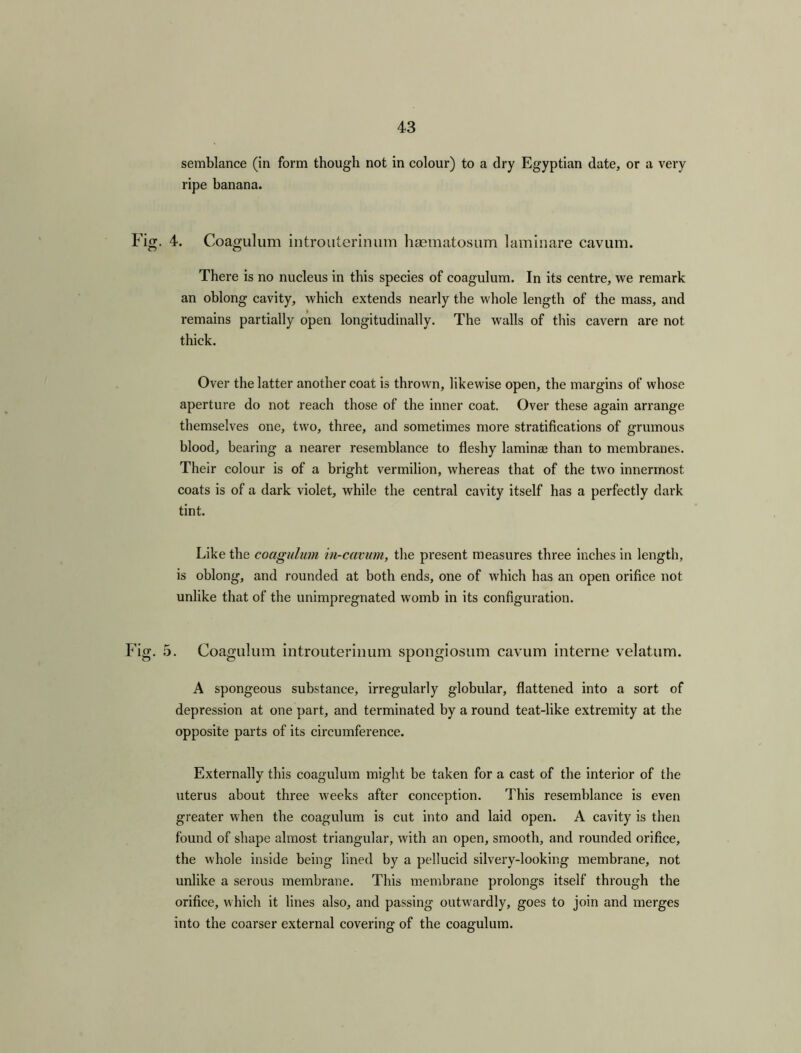 semblance (in form though not in colour) to a dry Egyptian date, or a very ripe banana. Fig. 4. Coagulum introuterinum haematosum laminare cavum. There is no nucleus in this species of coagulum. In its centre, we remark an oblong cavity, which extends nearly the whole length of the mass, and remains partially open longitudinally. The walls of this cavern are not thick. Over the latter another coat is thrown, likewise open, the margins of whose aperture do not reach those of the inner coat. Over these again arrange themselves one, two, three, and sometimes more stratifications of grumous blood, bearing a nearer resemblance to fleshy laminae than to membranes. Their colour is of a bright vermilion, whereas that of the two innermost coats is of a dark violet, while the central cavity itself has a perfectly dark tint. Like the coagulum in-cavum, the present measures three inches in length, is oblong, and rounded at both ends, one of which has an open orifice not unlike that of the unimpregnated womb in its configuration. Fig. 5. Coagulum introuterinum spongiosum cavum interne velatum. A spongeous substance, irregularly globular, flattened into a sort of depression at one part, and terminated by a round teat-like extremity at the opposite parts of its circumference. Externally this coagulum might be taken for a cast of the interior of the uterus about three weeks after conception. This resemblance is even greater when the coagulum is cut into and laid open. A cavity is then found of shape almost triangular, with an open, smooth, and rounded orifice, the whole inside being lined by a pellucid silvery-looking membrane, not unlike a serous membrane. This membrane prolongs itself through the orifice, which it lines also, and passing outwardly, goes to join and merges into the coarser external covering of the coagulum.