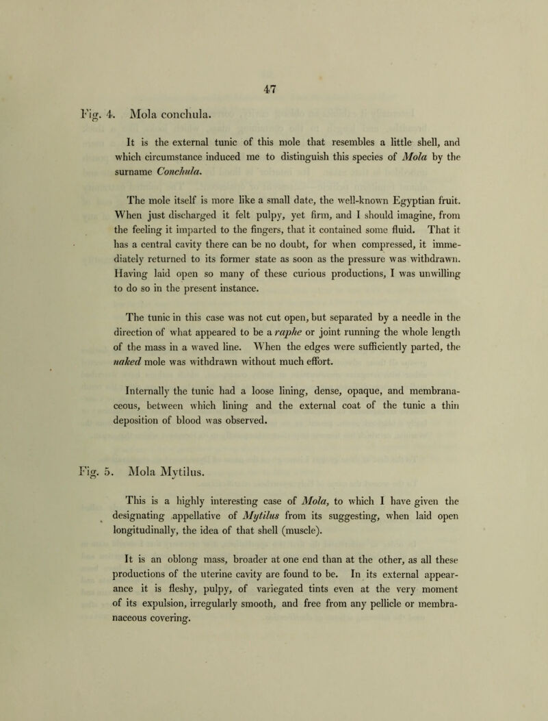 Fig. 4. Mol a conchula. It is the external tunic of this mole that resembles a little shell, and which circumstance induced me to distinguish this species of Mola by the surname Conchula. The mole itself is more like a small date, the well-known Egyptian fruit. When just discharged it felt pulpy, yet firm, and I should imagine, from the feeling it imparted to the fingers, that it contained some fluid. That it has a central cavity there can be no doubt, for when compressed, it imme- diately returned to its former state as soon as the pressure was withdrawn. Having laid open so many of these curious productions, I was unwilling to do so in the present instance. The tunic in this case was not cut open, but separated by a needle in the direction of what appeared to be a raphe or joint running the whole length of the mass in a waved line. When the edges were sufficiently parted, the naked mole was withdrawn without much effort. Internally the tunic had a loose lining, dense, opaque, and membrana- ceous, between which lining and the external coat of the tunic a thin deposition of blood was observed. Fig;. 5. Mola Mytilus. This is a highly interesting case of Mola, to which I have given the designating appellative of Mytilus from its suggesting, when laid open longitudinally, the idea of that shell (muscle). It is an oblong mass, broader at one end than at the other, as all these productions of the uterine cavity are found to be. In its external appear- ance it is fleshy, pulpy, of variegated tints even at the very moment of its expulsion, irregularly smooth, and free from any pellicle or membra- naceous covering.