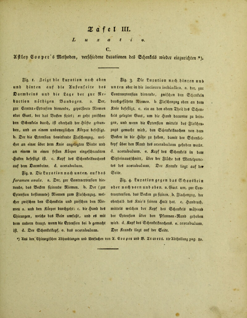£ ö f e l irr. L u x a t i 9. C, 2Cftlep ©oopet’S Sttetyoöen, verriebene Surationen beö ©4)cnfel§ tvieber emjuric^fen •*). gtg. r. Bergt bie ßupation rtacf> oben unb hinten auf bie tfufenfeite beö jDatmbeinS unb bie Sage bet gut 9i e; buction nöthigen SSanbagen. a. Ser, gut ©ontra; ©ptenfion bienenbe, gepolterte Oiiemen ober ©urt, ber baS Serfen fipirt; er gebt gwifdjen feen ©djenfeln burch, ifi oberhalb bet .fümfte gebum ben, unb an einem unbewcnlidjen itorper befefiigt. b. Set bie ©ptenfion bewitfenbe glafdhengug, wei- ther an einet übet bem ilnie angelegten SSinbe unb an einem tn einen fejien Äorper eingefcbraubten «£>afen befeftigt ifi. c, üopf beö ©chen?elfnod)en$ auf bem Satmbetne. d. acetabulum. Sig.2. Sie 2upa tion nach unten, aufbaö foramen ovale, a. Ser, gut ©ontraeptenfion bie= nenbe, ba$ SSecfen ftpirenbe Orienten. b. Ser (gut ©ptenfion bejiimmte) Oliemen gum Slafdbengug, tvel= «bet gwifchen ben ©djenfeln unb gwifdjen ben 9?ie; men a. unb ben Äorper burdbgebt; c. bie £anb be$ Chirurgen, welche ba6 SSein umfajjt, unb e$ mit bem anbetn freust, wenn bie ©ptenfion bei b gemacht ifi. d. Set ©djenfelfopf, e. baS acetabulum. ^ig. 3. Sie ßupation nach hinten unb unten ober in bie incisura ischiadica. a. ber, gut ©ontraeptenfion bienenbe, gwifcben ben ©chenfeltt burdjgefufjrte Orienten. b. glafdjengug oben an bem Änie befefiigt. c. ein an ben obern &beil be$ ©eben; fe(6 gelegter ©urt, um bie $anb barunter gu brin* gen, unb wenn bie ©ptenfion mittels beö glafche»* gugs gemacht wirb, ben ©chenfelfnodjen »on bem SSeden in bie £ofje gu heben, bamit bet ©djenfel; fopf übet ben Olanb beS acetabulum gehoben wetbe. d. acetabulum. e. Äopf beS ©djenfelS in bem ©i^beinauSfchnitt, fibet bet glddje beS Sttittelpunc; teS be$ acetabulum. Set Äranfe liegt auf ber ©eite. gig. 4. ßupation gegen baS©djooebein ober nad) Born unb oben. a. ©urt um, gur ©om traeptenfion, baS 23ecfen gu ftpiren. b. gladjengug, bet oberhalb beö Änie’S feinen £alt hat. c, $anbtud), mittels weldpen ber jlopf beS ©dtjenfelS wdhrenb ber ©ptenfion übet ben Pfannen = 9?anb gehoben wirb. d. Äopf beS ©d;enfelfnod;enS. e, acetabulum, Ser Ätanfe liegt auf bet ©eite. *) 2luS ben. 6f)irurgifd)en Whanblungen unb SSetfud^en ton 11, 600 per unb S3. SraoetS. itellbtheilung pag. 80.