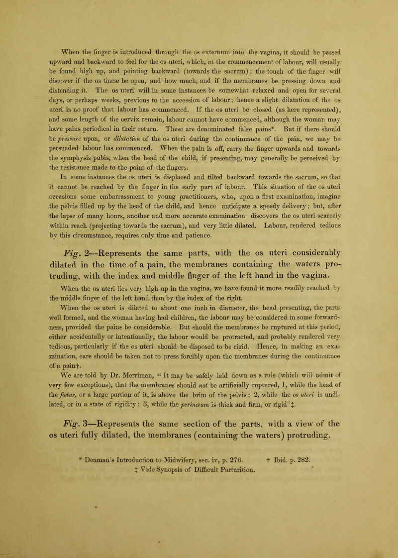 When the huger is introduced through the os externum into the vagina, it should be passed upward and backward to feel for the os uteri, which, at the commencement of labour, will usually be found high up, and pointing backward (towards the sacrum) ; the touch of the finger will discover if the os tincee be open, and how much, and if the membranes be pressing down and distending it. The os uteri will in some instances be somewhat relaxed and open for several days, or perhaps weeks, previous to the accession of labour; hence a slight dilatation of the os uteri is no proof that labour has commenced. If the os uteri be closed (as here represented), and some length of the cervix remain, labour cannot have commenced, although the woman may have pains periodical in their return. These are denominated false pains*. But if there should be pressure upon, or dilatation of the os uteri during the continuance of the pain, we may be persuaded labour has commenced. When the pain is off, carry the finger upwards and towards the symphysis pubis, when the head of the child, if presenting, may generally be perceived by the resistance made to the point of the fingers. In some instances the os uteri is displaced and tilted backward towards the sacrum, so that it cannot be reached by the finger in the early part of labour. This situation of the os uteri occasions some embarrassment to young practitioners, who, upon a first examination, imagine the pelvis filled up by the head of the child, and hence anticipate a speedy delivery ; but, after the lapse of many hours, another and more accurate examination discovers the os uteri scarcely within reach (projecting towards the sacrum), and very little dilated. Labour, rendered tedious by this circumstance, requires only time and patience. Fig. 2—Represents the same parts, with the os uteri considerably dilated in the time of a pain, the membranes containing the waters pro- truding, with the index and middle finger of the left hand in the vagina. When the os uteri lies very high up in the vagina, we have found it more readily reached by the middle finger of the left hand than by the index of the right. When the os uteri is dilated to about one inch in diameter, the head presenting, the parts well formed, and the woman having had children, the labour may be considered in some forward- ness, provided the pains be considerable. But should the membranes be ruptured at this period, either accidentally or intentionally, the labour would be protracted, and probably rendered very tedious, particularly if the os uteri should be disposed to be rigid. Hence, in making an exa- mination, care should be taken not to press forcibly upon the membranes during the continuance of a painf. We are told by Dr. Merriman, “ It may be safely laid down as a rule (which will admit of very few exceptions), that the membranes should not be artificially ruptured, 1, while the head of the foetus, or a large portion of it, is above the brim of the pelvis ; 2, while the os -uteri is undi- lated, or in a state of rigidity ; 3, while the perinceum is thick and firm, or rigid” Fig. 3—Represents the same section of the parts, with a view of the os uteri fully dilated, the membranes (containing the waters) protruding. * Denman’s Introduction to Midwifery, sec. iv, p. 276. t Ibid. p. 282. ^ Vide Synopsis of Difficult Parturition.