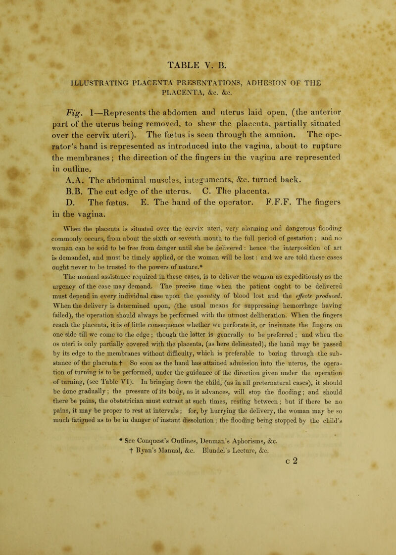 ILLUSTRATING PLACENTA PRESENTATIONS, ADHESION OF THE PLACENTA, &c. &c. Fig. 1—Represents the abdomen and uterus laid open, (the anterior part of the uterus being removed, to shew the placenta, partially situated over the cervix uteri). The foetus is seen through the amnion. The ope- rator’s hand is represented as introduced into the vagina, about to rupture the membranes; the direction of the fingers in the vagina are represented in outline. A. A. The abdominal muscles, integuments, &c. turned back. B. B. The cut edge of the uterus. C. The placenta. D. The foetus. E. The hand of the operator. F.F.F. The fingers in the vagina. When the placenta is situated over the cervix uteri, very alarming and dangerous flooding commonly occurs, from about the sixth or seventh month to the full period of gestation ; and no woman can be said to be free from danger until she be delivered : hence the interposition of art is demanded, and must be timely applied, or the woman will be lost: and we are told these cases ought never to be trusted to the powers of nature.* The manual assistance required in these cases, is to deliver the woman as expeditiously as the urgency of the case may demand. The precise time when the patient ought to be delivered must depend in every individual case upon the quantity of blood lost and the effects produced. When the delivery is determined upon, (the usual means for suppressing hemorrhage having failed), the operation should always be performed with the utmost deliberation. When the fingers reach the placenta, it is of little consequence whether we perforate it, or insinuate the fingers on one side till we come to the edge ; though the latter is generally to be preferred ; and when the os uteri is only partially covered with the placenta, (as here delineated), the hand may be passed by its edge to the membranes without difficulty, which is preferable to boring through the sub- stance of the placenta.+ So soon as the hand has attained admission into the uterus, the opera- tion of turning is to be performed, under the guidance of the direction given under the operation of turning, (see Table VI). In bringing down the child, (as in all preternatural cases), it should be done gradually ; the pressure of its body, as it advances, will stop the flooding; and should there be pains, the obstetrician must extract at such times, resting between; but if there be no pains, it may be proper to rest at intervals; for, by hurrying the delivery, the woman may be so much fatigued as to be in danger of instant dissolution; the flooding being stopped by the child’s * See Conquest’s Outlines, Denman’s Aphorisms, &c. t Ryan’s Manual, &c. Blundel's Lecture, &c. c 2