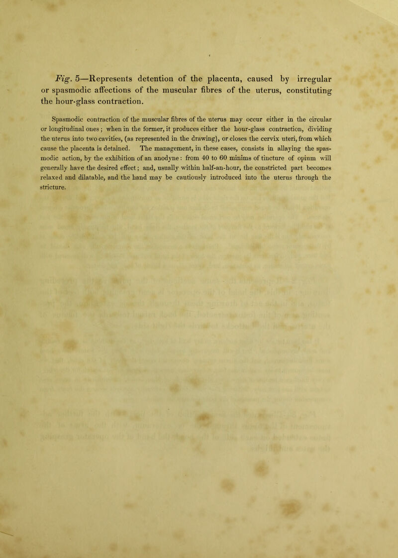 Fig. 5—Represents detention of the placenta, caused by irregular or spasmodic affections of the muscular fibres of the uterus, constituting the hour-glass contraction. Spasmodic contraction of the muscular fibres of the uterus may occur either in the circular or longitudinal ones ; when in the former, it produces either the hour-glass contraction, dividing the uterus into two cavities, (as represented in the drawing), or closes the cervix uteri, from which cause the placenta is detained. The management, in these cases, consists in allaying the spas- modic action, by the exhibition of an anodyne : from 40 to 60 minims of tincture of opium will generally have the desired effect; and, usually within half-an-hour, the constricted part becomes relaxed and dilatable, and the hand may be cautiously introduced into the uterus through the stricture.