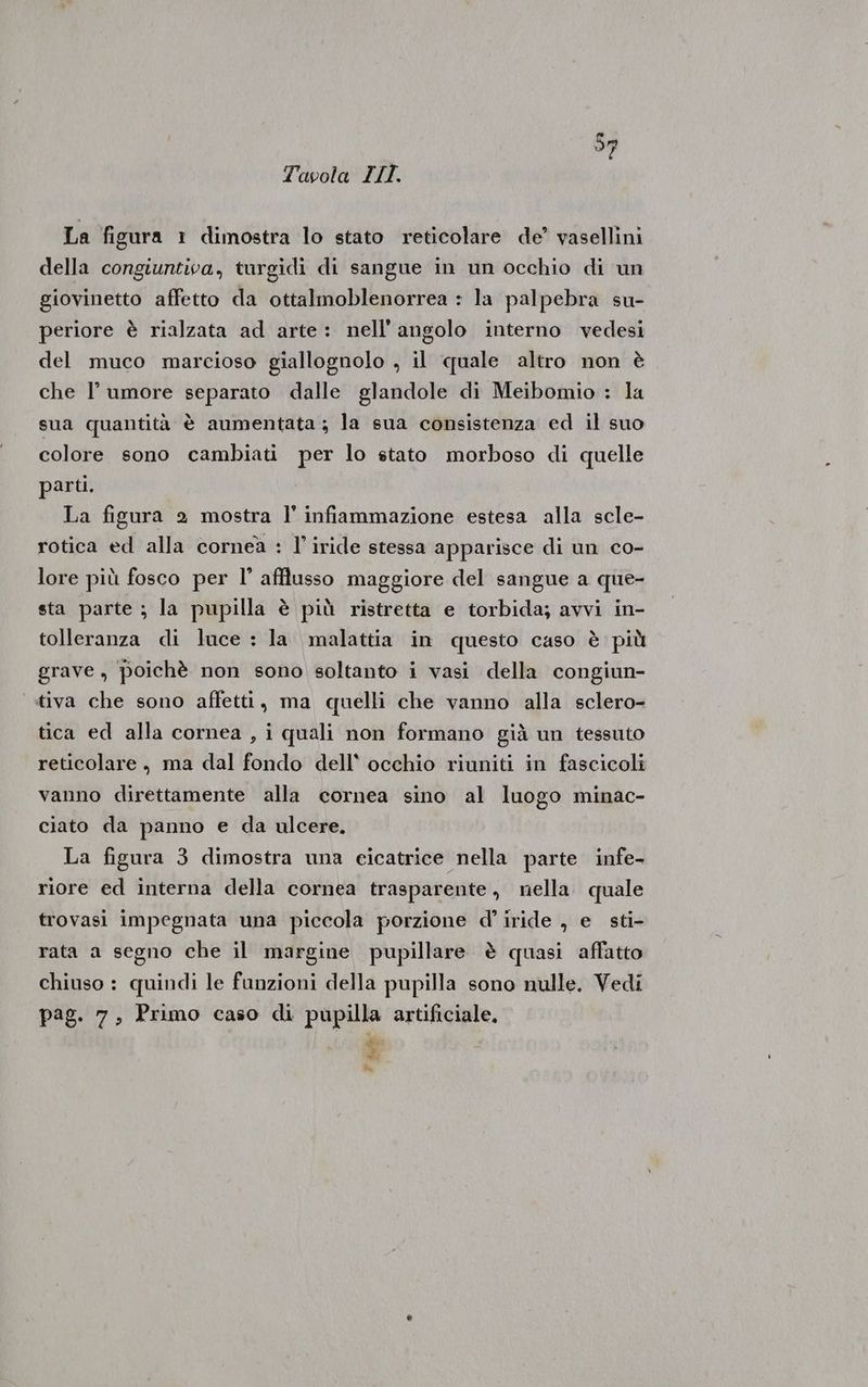 La figura 1 dimostra lo stato reticolare de’ vasellini della congiuntiva, turgidi di sangue in un occhio di un giovinetto affetto da ottalmoblenorrea : la palpebra su- periore è rialzata ad arte: nell'angolo interno vedesi del muco marcioso giallognolo , il quale altro non è che l'umore separato dalle glandole di Meibomio : la sua quantità è aumentata ; la sua consistenza ed il suo colore sono cambiati per lo stato morboso di quelle parti. La figura 2 mostra l’ infiammazione estesa alla scle- rotica ed alla cornea : l’ iride stessa apparisce di un co- lore più fosco per l’ afflusso maggiore del sangue a que- sta parte ; la pupilla è più ristretta e torbida; avvi in- tolleranza di luce : la malattia in questo caso è più grave , poichè non sono soltanto i vasi della congiun- tiva che sono affetti, ma quelli che vanno alla sclero- tica ed alla cornea , i quali non formano già un tessuto reticolare, ma dal fondo dell* occhio riuniti in fascicoli vanno direttamente alla cornea sino al luogo minac- ciato da panno e da ulcere. La figura 3 dimostra una eicatrice nella parte infe- riore ed interna della cornea trasparente, nella quale trovasi impegnata una piccola porzione d’ iride , e sti- rata a segno che il margine pupillare è quasi affatto chiuso : quindi le funzioni della pupilla sono nulle. Vedi pag. 7, Primo caso di pupilla artificiale, È da;
