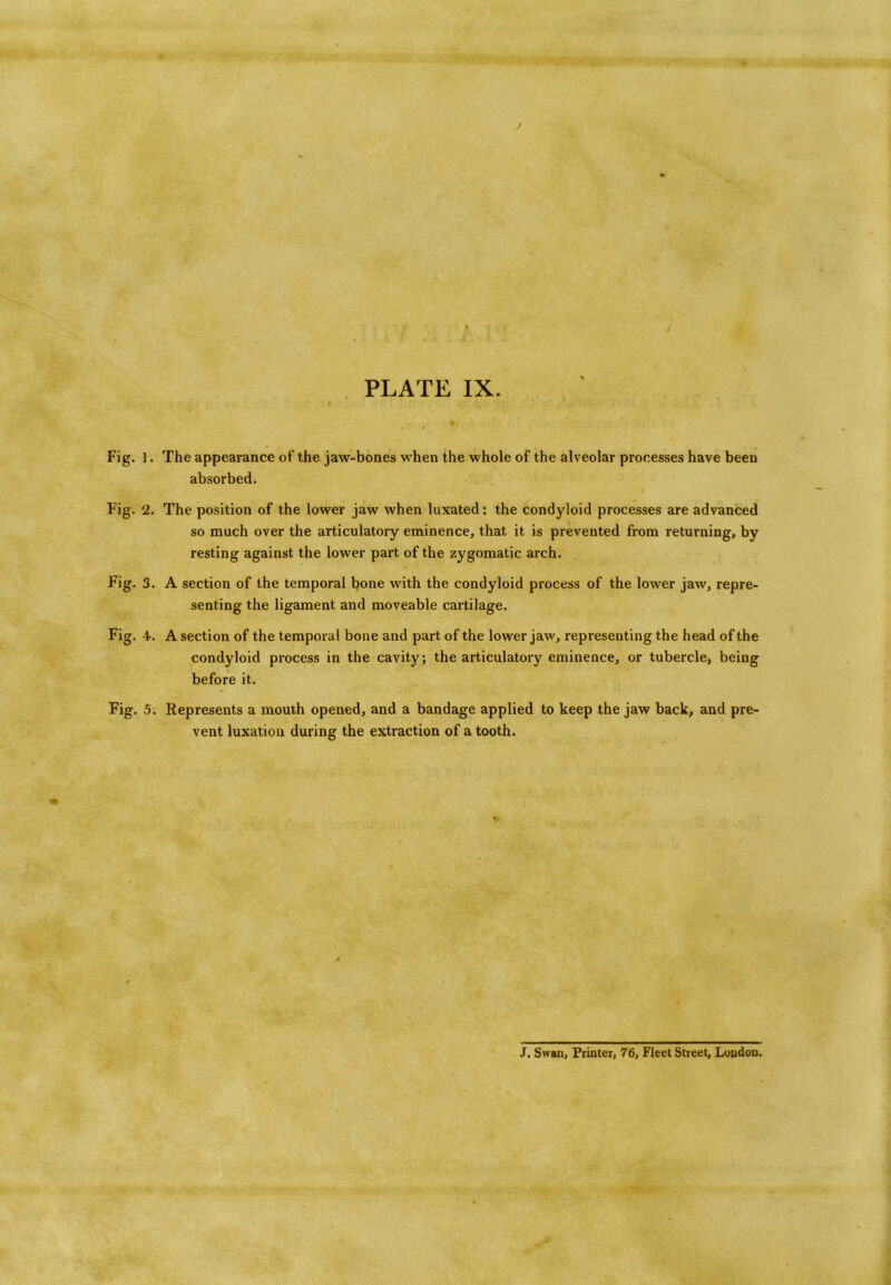 Fig. 1. The appearance of the jaw-bones when the whole of the alveolar processes have been absorbed. Fig. 2. The position of the lower jaw when luxated : the condyloid processes are advanced so much over the articulatory eminence, that it is prevented from returning, by resting against the lower part of the zygomatic arch. Fig. 3. A section of the temporal bone with the condyloid process of the lower jaw, repre- senting the ligament and moveable cartilage. Fig. 4. A section of the temporal bone and part of the lower jaw, representing the head of the condyloid process in the cavity; the articulatory eminence, or tubercle, being before it. Fig. 5. Represents a mouth opened, and a bandage applied to keep the jaw back, and pre- vent luxation during the extraction of a tooth. J. Swan, Printer, 76, Fleet Street, London.