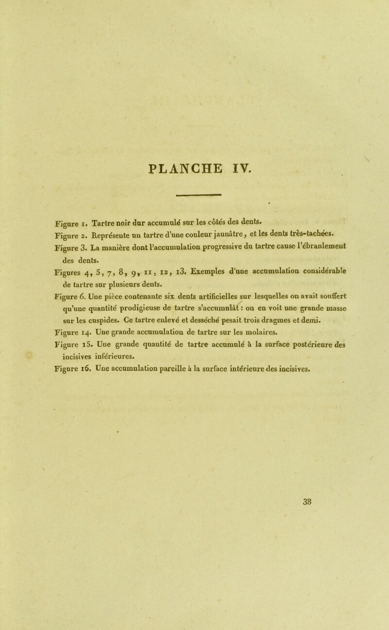 I PLANCHE IV. Figure I. Tartre noir dur accumold sur les cote's des dents. Figure 2. Repre'seute nn tartre d’une couleur jaunatre, et les dents tres-tachees. Figure 3. La maniere dont I’accumulation progressive du tartre cause Tebranlemeut des dents. Figures 4, 5, 7, 8, 9, ii, I2, i3. Exemples d'nne accumulation considerable de tartre sur plusienrs dents. Figure 6. Une piece contenaiite six dents artificielles sur lesquelles on avail sonffert qn’nne quantite prodigieuse de tartre s’accumulat: on en voit une grande masse sur les cuspides. Ce tartre enleve et desseche pesait trois dragmes et demi. Figure 14. Une grande accumulation de tartre sur les molaires. Figure 15. Une grande quantite de tartre accnmule a la surface posterienre des incisives inferieures. Figure 16. Une accumulation pareille a la surface interieure des incisives. 38