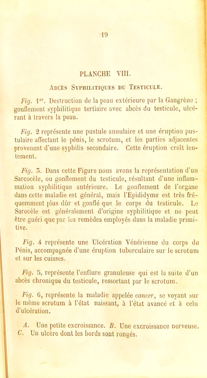 PLANCHE VIII. ABCfeS SvPUIUTIQUES DU TeSTICULE. Fig. Desi.ruclion de la peau exlerieure par la Gangrene ; gonllement syphilitiqiie tertiaire avec abccs du lesticule, ulce- rant ^ travers la peau. Fig. 2 represente une pustule annulaire et une eruption pus- tulaire affectant le p^nis, le scrotum, et les parties adjacentes provenant d’une syphilis secondaire. Cette eruption croU len- teraent. Fig. 5. Dans cette Figure nous avons la representation d’un SarcocMe, ou gonfleinent du testicule, resultant d’une inflam- mation syphililique anterieure. Le gonllement de I’organe dans cette maladie est general, mais I’Epididyme est tres fre- quemment plus dur et gonfle que le corps du testicule. Le Sarocele est gdndralement d’origine sypliilitique et ne peut etre gudri que par les l emMes employes dans la maladie primi- tive. Fig. 4 represente une Ulcdration Yeuerienne du corps du Penis, accompagnee d'une eruption tuberculaire sur le scrotum et sur les cuisses. Fig. S, represente I’enflure granuleuse qui est la suite d’un abces chronique du testicule, ressortant par le scrotum. Fig. G, represente la maladie appelde cancer, sc voyant sur le niGine scrotum Ii I’elat naissant, h I’etat avance et h celu d’ulcdration. A. Une petite excroissanco. B. Une excroissance nerveusc. C. Un ulcere dont les bords sont ronges.