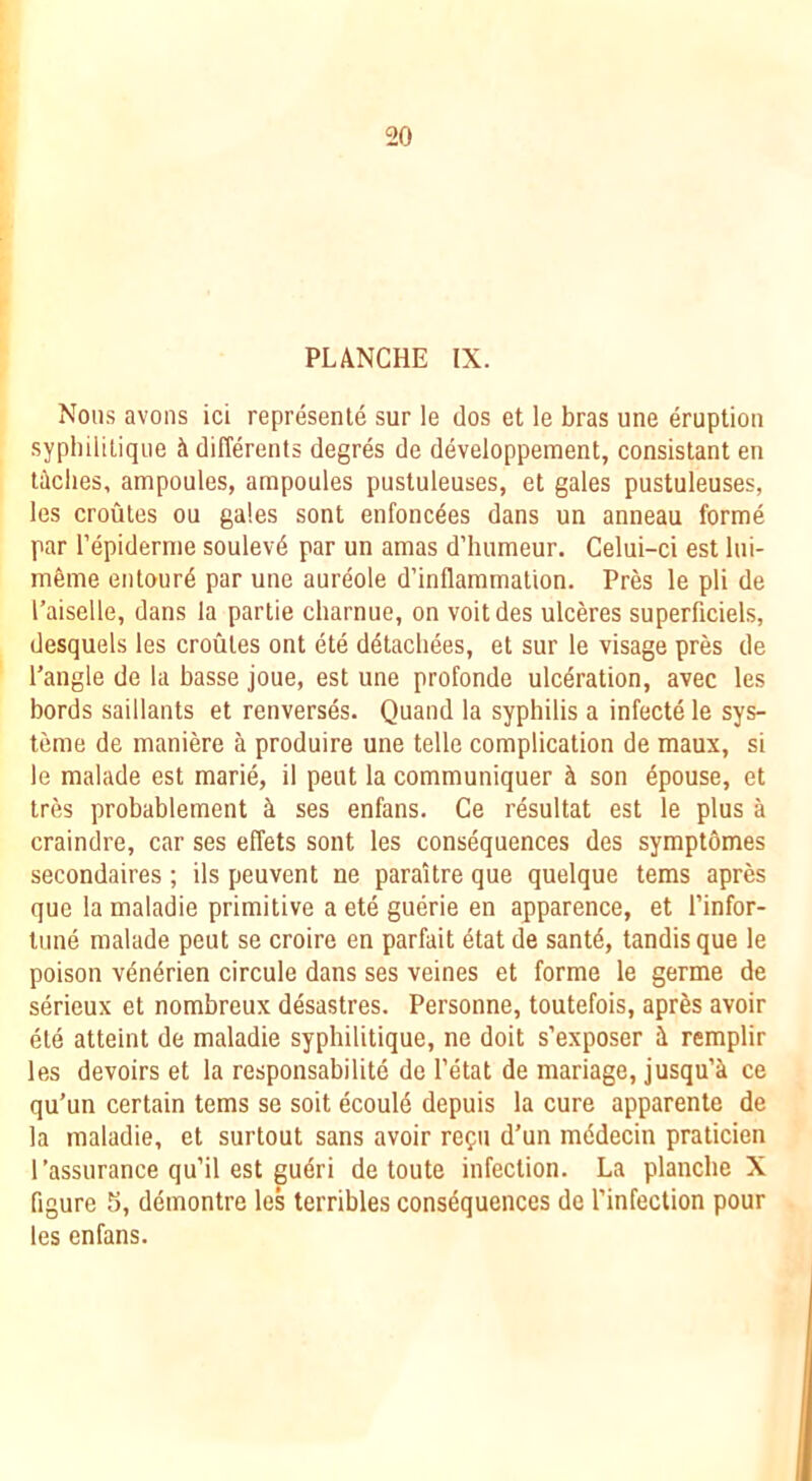 PLANCHE IX. Nous avons ici represente sur le dos et le bras une eruption sypliilitique ci differents degres de developpement, consistant en tidies, ampoules, ampoules pustuleuses, et gales pustuleuses, les croutes ou gales sent enfonc^es dans un anneau forme par Tepiderme soulev6 par un amas d’humeur. Celui-ci est lui- mime eiitour^ par une aureole d’inflammation. Pres le pli de I’aiselle, dans la partie charnue, on voitdes ulceres superficiels, desquels les croutes ont ete ddacliees, et sur le visage pres de Tangle de la basse joue, est une profonde ulceration, avec les bords saillants et renverses. Quand la syphilis a infecte le sys- teme de maniere a produire une telle complication de maux, si le malade est marie, il pent la communiquer i son 4pouse, et tres probablement i ses enfans. Ce resultat est le plus a craindre, car ses effets sent les consequences des symptomes secondaires ; ils peuvent ne paraitre que quelque terns apres que la maladie primitive a ete guerie en apparence, et Tinfor- tiine malade peut se croire en parfait etat de sant4, tandis que le poison vdn^rien circule dans ses veines et forme le germe de serieux et nombreux desastres. Personne, toutefois, aprfes avoir ete atteint de maladie sypliilitique, ne doit s’exposer i remplir les devoirs et la responsabilite de Tetat de manage, jusqu’i ce qu’un certain terns se soit ecoul6 depuis la cure apparente de la maladie, et surtout sans avoir repii d’un mddecin praticien Tassurance qu’il est gudri de toute infection. La planclie X figure 5, demontre les terribles consequences do Tinfection pour les enfans.