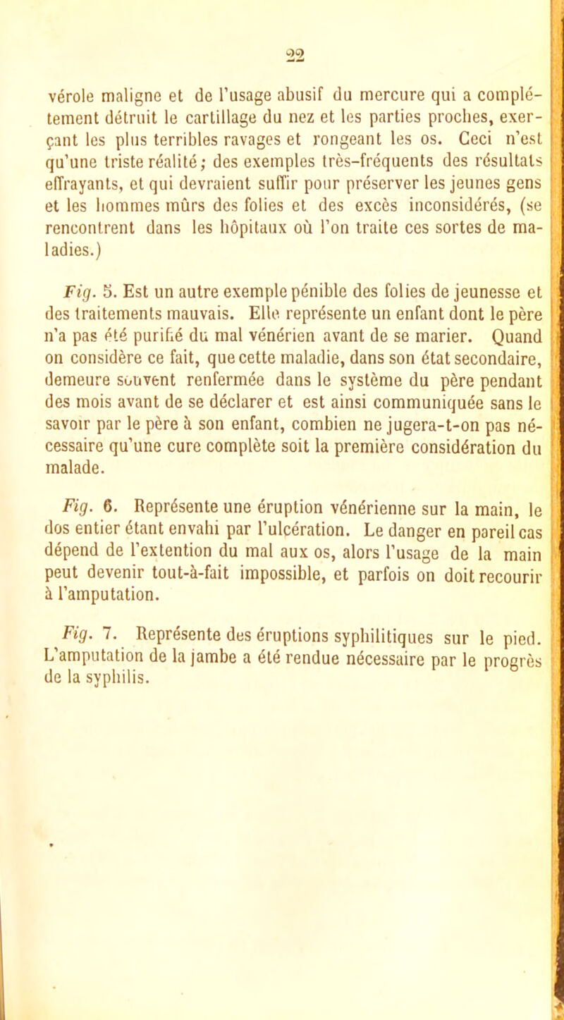 verole maligne et de I’usage abusif du mercure qui a comple- tement detniit le carlillage du nez et les parties proclies, exer- fant les plus terribles ravages et rongeant les os. Ceci n’est qu’une triste realite; des exeinples tres-frequents des rdsultals elTrayants, et qui devraient sufTir pour preserver les jeunes gens et les liommes murs des folies et des exces iiiconsideres, (se rencontrent dans les hopitaux ou Ton traile ces sortes de ma- ladies.) Fig. S. Est un autre example penible des folies de jeunesse et des traitements mauvais. Elle represente un enfant dont le pere n’a pas et4 purifie du mal venerien avant de se marier. Quand on considere ce fait, que cette maladie, dans son 4tat secondaire, demeure souvent renfermee dans le systeme du p4re pendant des mois avant de se declarer et est ainsi communiquee sans le savoir par le p4re son enfant, combien ne jugera-t-on pas ne- cessaire qu’une cure complete soil la premiere considdration du malade. Fig. 6. Reprdsente une eruption vdndrienne sur la main, le dos entier dtant envahi par I’ulceration. Le danger en pared cas depend de I’extention du mal aux os, alors I’usage de la main pent devenir tout-a-fait impossible, et parfois on doit recourir i I’amputation. Fig. 1. Represente des eruptions syphilitiques sur le pied. L’amputation de la jambe a die rendue ndcessaire par le progres de la syphilis.