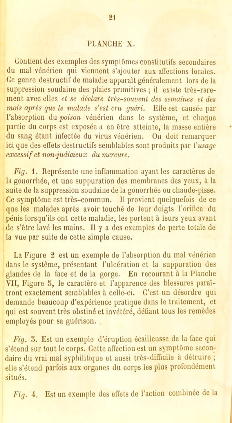 21 PLANCHE X. t’oiitientdes exemples des symplomes constilulifs secondaires du mal vdnerien qui viennenl s’ajouter aux affeclions locales. Ge genre destruclif de maladie apparait g^neralemeiU lors de la suppression soudaine des plaies primitives; il exisle Ires-rare- ment avec dies et se declare tres-souvent des semaines et des mois apres que le malade s'est cru gueri. Elle est causee par I’absorplion du poison venerien dans le systeme, et cliaque partie du corps est exposee a en etre atteinte, la masse entiere du sang etant infectee du virus venerien. On doit remarquer ici que des efl'ets deslructifs semblables sont produils par ['usage excessifet non-judicieux du mercure. Fig. 1. Repr^sente une inflammation ayant les caracleres de la gonorrbde, et une suppuration des membranes des yeux, a la suite de la suppression soudaine de la gonorrhee ou chaude-pisse. Ce symptome est tres-commun. II provient quelquefois de ce que les malades apres avoir touche de leur doigts Torilice du penis lorsqu’ils ont cetle maladie, les portent a leurs yeux avant de s’etre lave les mains. II y a des exemples de perle tolale de la vue par suite de cette simple cause. La Figure 2 est un exemple de I’absorption du mal venerien dans le systeme, presentant I’ulcdration et la suppuration des glandes de la face et de la gorge. En recourant a la Planclie VII, Figure 5, le caraclere et I’apparence des blessures parai- tront exactement semblables a celle-ci. G’est un desordre qui demande beaucoup d’expdrience pratique dans le iraitement, et qui est souvent tres obstind et invdterd, delianl lous les remedes employes pour sa gudrison. Fig. 3. Est un exemple d’eruplion dcailleusse de la face qui s’etend sur tout le corps. Gette affection est un symplOme secon- daire du vrai mal syphilitique et aussi tres-difficilc a delruire ; elle s’elcnd parfois aux organes du corps les plus profonddmenl situds. Fig. 4. Est un exemple des effels de I’aclion combinee de la