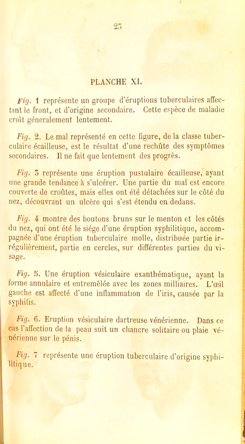 PLANCHE XI. Fig. 1 represenle un groiipe d’eruptions tuberculnires aflec- tnnt le front, et d’origine secondaire. Cette espece de maladie croU generalement lentement. Fig. 2. Le mal reprdsente en cette figure, de la classe tuber- ciilaire ecailleuse, est le resultat d’une recbClte des symptomes secondaires. II ne fait que lentement des progres. Fig. 5 represente une eruption pustulaire dcailleuse, ayant line grande tendance s’ulcdrer. Une partie du mal est encore couverte de croutes, mais elles ont ete detachees sur le cote du nez, decouvrant un ulcere qui s’est etendu en dedans. Fig. 4 montre des boutons bruns sur le menton et les cotes dll nez, qui ont ete le siege d’une eruption syphilitique, accom- pagnde d’une Eruption luberculaire molle, distribute partie ir- regulierement, partie en cercles, sur difftrentes parties du vi- sage. Fig. 5. Une eruption vtsiculaire exanthtmatique, ayant la forme annulaire et entremelee avec les zones milliaires. L’ceil gauche est affectt d’une inflammation de I’iris, causee par la syphilis. Fig. 6. Eruption vesiculaire dartreuse ventrienne. Dans ce cas I’affection de la peau suit un chancre solitaire ou plaie ve- ndrienne sur le ptnis. Fig. 7 reprtsente une eruption luberculaire d’origine syplii- litique.