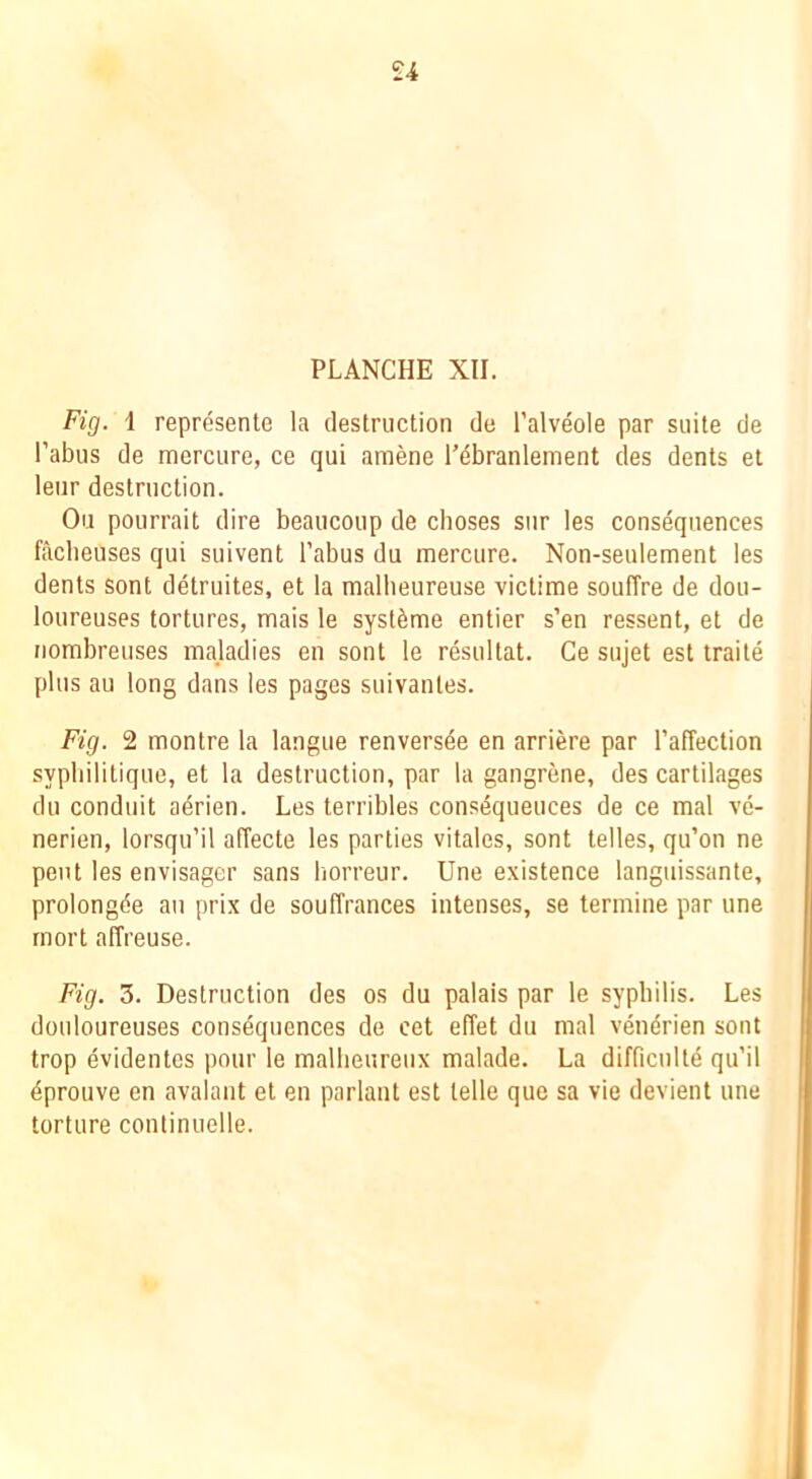 £4 PLANCHE XII. Fig. i represente la destruction de I’alveole par suite de I’abus de mercure, ce qui ainene Tebranlement des dents et leur destruction. Ou pourrait dire beaucoup de choses sur les consequences facbeuses qui suivent Tabus du mercure. Non-seulement les dents sont detruites, et la mallieureuse victime souffre de dou- loureuses tortures, mais le syst^me entier s’en ressent, et de nombreuses majadies en sont le resultat. Ge sujet est traile plus au long dans les pages suivantes. Fig. 2 montre la langue renvers^e en arriere par TalTection sypbilitique, et la destruction, par la gangrene, des cartilages du conduit a^rien. Les terribles consequences de ce mal ve- nerien, lorsqu’il affecte les parties vitales, sont telles, qiTon ne pent les envisager sans borreur. Une existence langiiissante, prolongde au prix de souffrances intenses, se termine par une rnort alTreuse. Fig. 3. Destruction des os du palais par le syphilis. Les douloureuses consequences de cet effet du mal vendrien sont trop evidentes pour le malbeureiix malade. La difficulte qu’il dprouve en avalant et en parlant est telle que sa vie devient une torture continuelle.