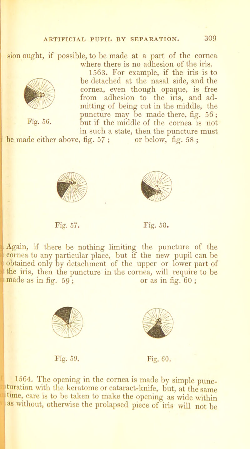 sion ought, if possible, to be made at a part of the cornea where there is no adhesion of the iris. 1563. For example, if the iris is to he detached at the nasal side, and the cornea, even though opaque, is free from adhesion to the iris, and mitting of being cut in the middle, puncture may be made there, fig. but if the middle of the cornea is Fig. 56. ad- the 56; not be made either above, fig. 57 ; in such a state, then the puncture must or below, fig. 58 ; Fig. 57. Fig. 58. Again, if there be nothing limiting the puncture of the cornea to any particular place, but if the new pupil can be obtained only by detachment of the upper or lower part of the iris, then the puncture in the cornea, will require to be made as in fig. 59; or as in fig. 60 ; Fig. 59. Fig. 60. 1564. The opening in the cornea is made by simple punc- turation with the keratome or cataract-knife, but, at the same time, care is to be taken to make the opening as wide within as without, otherwise the prolapsed piece of iris will not be