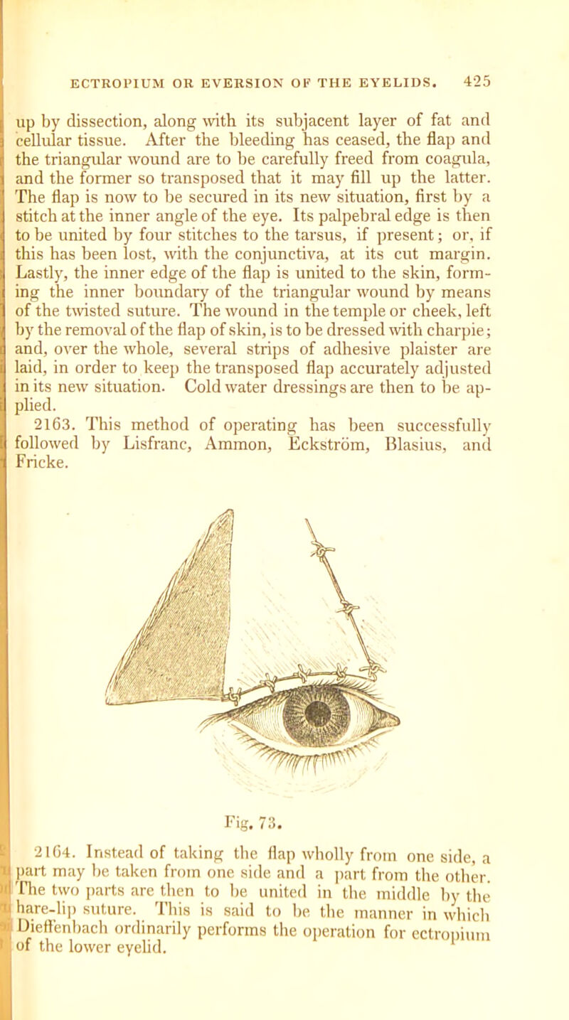 up by dissection, along with its subjacent layer of fat and cellular tissue. After the bleeding has ceased, the flap and the triangular wound are to be carefully freed from coagula, and the former so transposed that it may fill up the latter. The flap is now to lie secured in its new situation, first by a stitch at the inner angle of the eye. Its palpebral edge is then to be united by four stitches to the tarsus, if present; or, if this has been lost, with the conjunctiva, at its cut margin. Lastly, the inner edge of the flap is united to the skin, form- ing the inner boundary of the triangular wound by means of the twisted suture. The wound in the temple or cheek, left by the removal of the flap of skin, is to be dressed with charpie; and, over the whole, several strips of adhesive plaister are laid, in order to keep the transposed flap accurately adjusted in its new situation. Cold water dressings are then to be ap- plied. 2163. This method of operating has been successfully followed by Lisfranc, Ammon, Eckstrom, Blasius, and Fricke. Fig. 73. 2104. Instead of taking tbe flap wholly from one side, a part may be taken from one side and a part from the other, file two parts are then to be united in the middle by the hare-lip suture. This is said to be the manner in which Dieffenbach ordinarily performs the operation for cctropium of the lower eyelid.