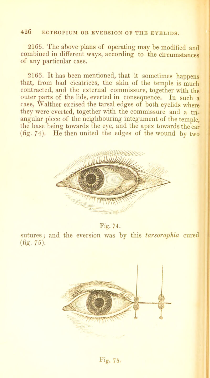 2165. The above plans of operating may be modified and combined in different ways, according to the circumstances of any particular case. 2166. It has been mentioned, that it sometimes happens that, from bad cicatrices, the skin of the temple is much contracted, and the external commissure, together with the outer parts of the lids, everted in consequence. In such a case, Walther excised the tarsal edges of both eyelids where they were everted, together with the commissure and a tri- angular piece of the neighbouring integument of the temple, the base being towards the eye, and the apex towards the ear (fig. 74). He then united the edges of the wound by two Fig. 74. sutures; and the eversion was by this tarsoraphia cured (fig. 75). Fig. 75.