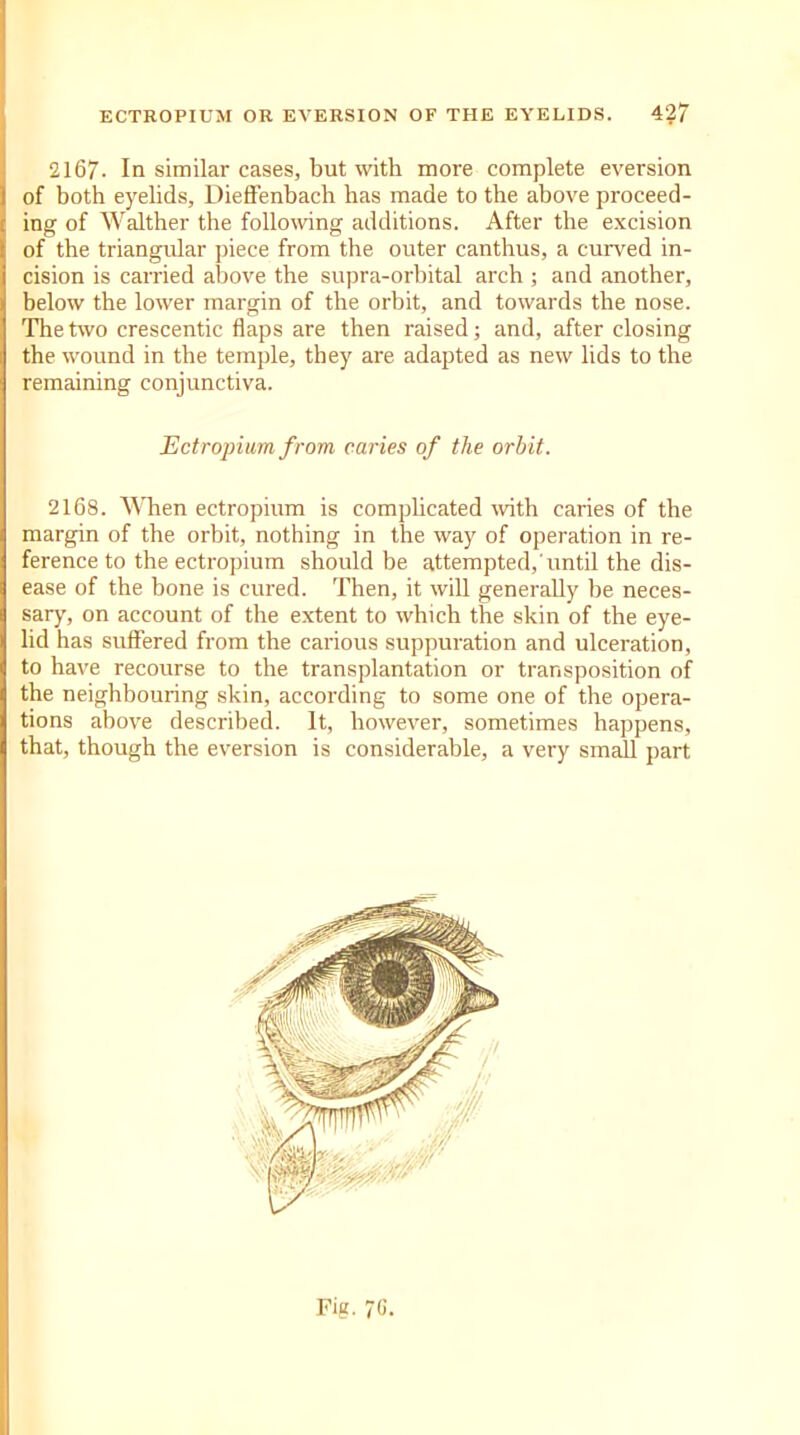 2167- In similar cases, but with more complete eversion of both eyelids, Dieffenbach has made to the above proceed- ing of Walther the following additions. After the excision of the triangular piece from the outer canthus, a curved in- cision is carried above the supra-orbital arch ; and another, below the lower margin of the orbit, and towards the nose. The two crescentic flaps are then raised; and, after closing the wound in the temple, they are adapted as new lids to the remaining conjunctiva. 2168. When ectropinm is complicated with caries of the margin of the orbit, nothing in the way of operation in re- ference to the ectropium should be attempted,'until the dis- ease of the bone is cured. Then, it will generally be neces- sary, on account of the extent to which the skin of the eye- lid has suffered from the carious suppuration and ulceration, to have recourse to the transplantation or transposition of the neighbouring skin, according to some one of the opera- tions above described. It, however, sometimes happens, that, though the eversion is considerable, a very small part Ectropium from, caries of the orbit.