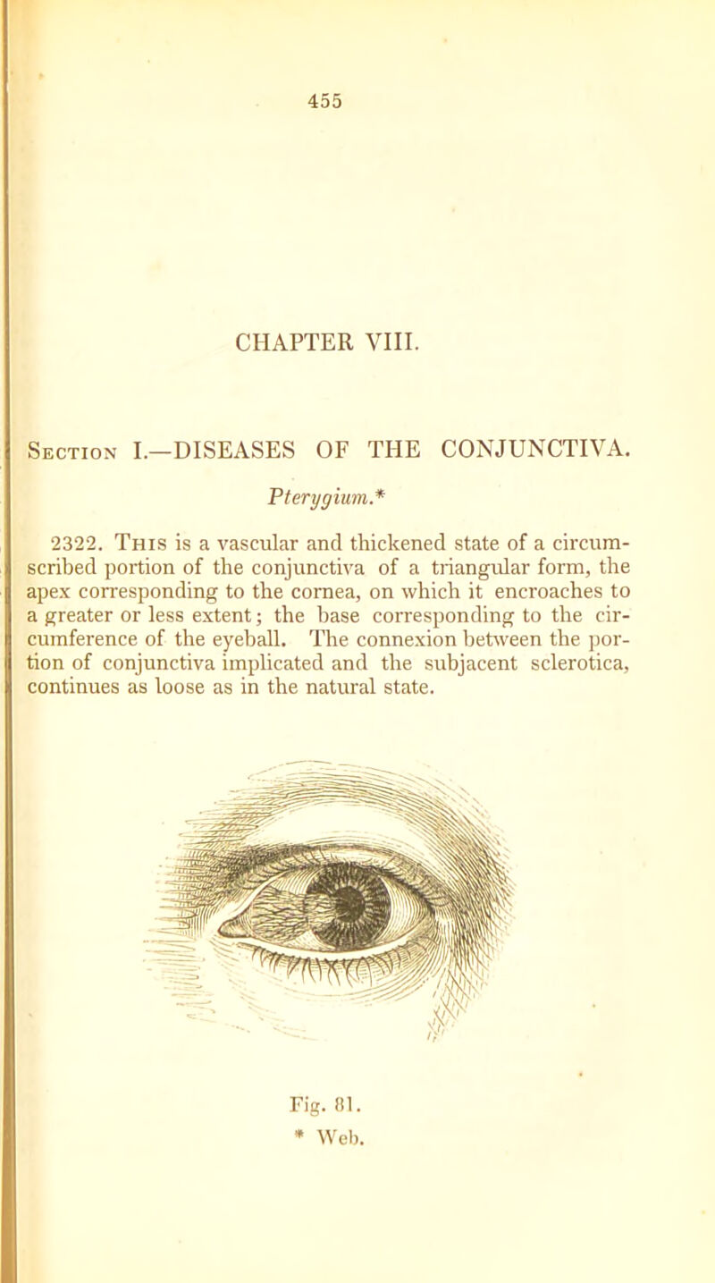 CHAPTER VIII. Section I.—DISEASES OF THE CONJUNCTIVA. Pterygium.* 2322. This is a vascular and thickened state of a circum- scribed portion of the conjunctiva of a triangular form, the apex corresponding to the cornea, on which it encroaches to a greater or less extent; the base corresponding to the cir- cumference of the eyeball. The connexion between the por- tion of conjunctiva implicated and the subjacent sclerotica, continues as loose as in the natural state. Fig. 81. * Web.