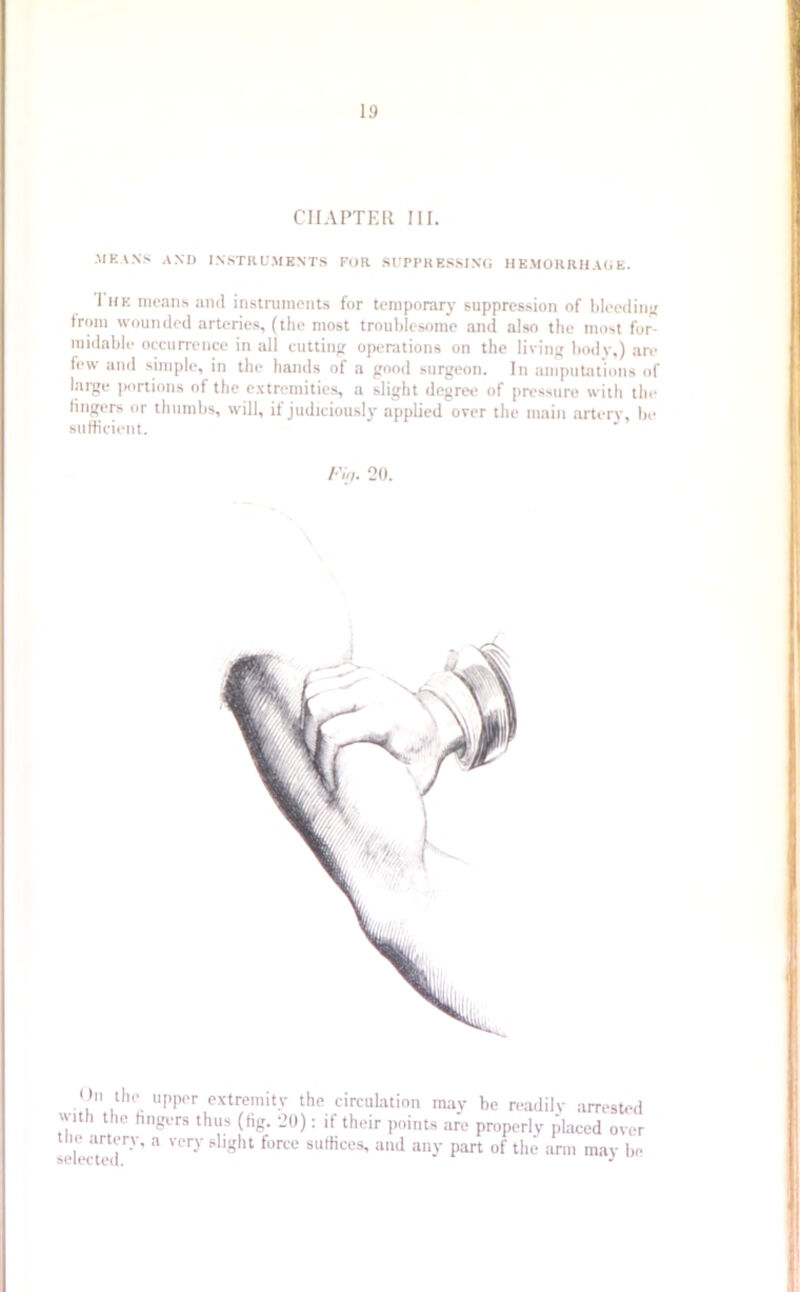 CHAPTER III. MEANS AND INSTRUMENTS FOR SUPPRESSING HEMORRHAGE. I he means and instruments for temporary suppression of bleeding from wounded arteries, (the most troublesome and also the most for- midable occurrence in all cutting operations on the living body,) are few and simple, in the hands of a good surgeon. In amputations of large portions of the extremities, a slight degree of pressure with the fingers or thumbs, will, it judiciously applied over the main artery, ho sufficient. 20. . . .tlu>. uPPor extremity the circulation may be readily arrested . hSL‘rs thus (fig- 20): 'f their points are properly placed over tlie artery, a very slight force suffices, and any part of the arm may be