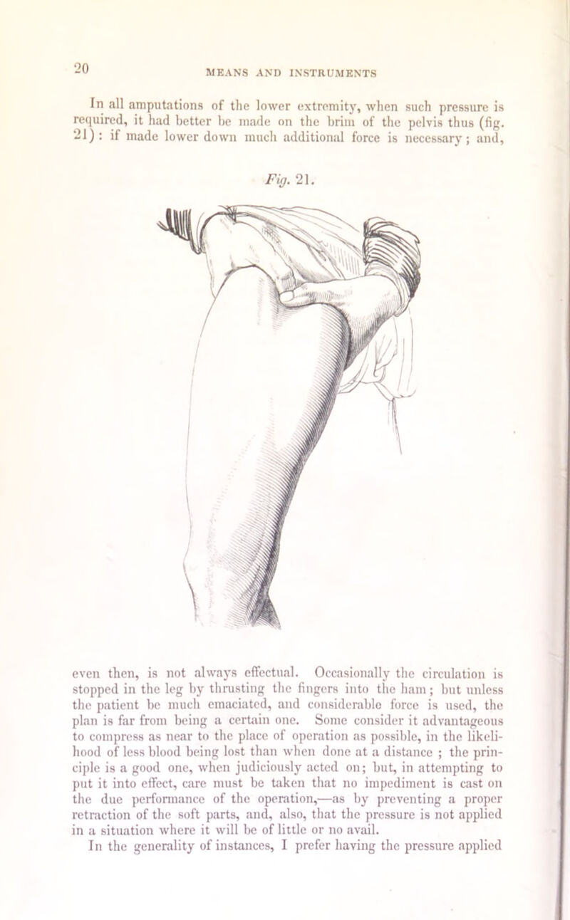 MEANS AND INSTRUMENTS In all amputations of the lower extremity, when such pressure is required, it had better be made on the brim of the pelvis thus (fig. 21): if made lower down much additional force is necessary; and, Fig. 21. even then, is not always effectual. Occasionally the circulation is stopped in the leg by thrusting the fingers into the ham; but unless the patient be much emaciated, and considerable force is used, the plan is far from being a certain one. Some consider it advantageous to compress as near to the place of operation as possible, in the likeli- hood of less blood being lost than when done at a distance ; the prin- ciple is a good one, when judiciously acted on; but, in attempting to put it into effect, care must be taken that no impediment is cast on the due performance of the operation,—as by preventing a proper retraction of the soft parts, and, also, that the pressure is not applied in a situation where it will be of little or no avail. In the generality of instances, I prefer having the pressure applied