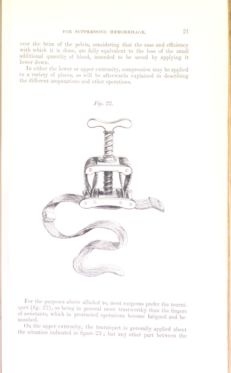 over the lirim of the pelvis, considering that the ease and efficiency with which it is done, are fully equivalent to the loss of the smail additional quantity of blood, intended to be saved by applying it lower down. In either the lower or upper extremity, compression may be applied in a variety of places, as will be afterwards explained in describing the different amputations and other operations. Fin. 2‘ V’* 1he.-,l’“rpose1s above a,luded to* »'°st surgeons prefer the tourni- juet (tig. as being in general more trustworthy than the fingers .1 assistants, which in protracted operations become fatigued and be- numbed. e 1'tu the purposes above alluded to, most surgeons prof quet (fiff. 22), as beinff in (Tftnpml ninru t »*vk .L of numbed. On the upper extremity, the tourniquet is generally applied about the situation indicated in figure 23 ; but any other part between the