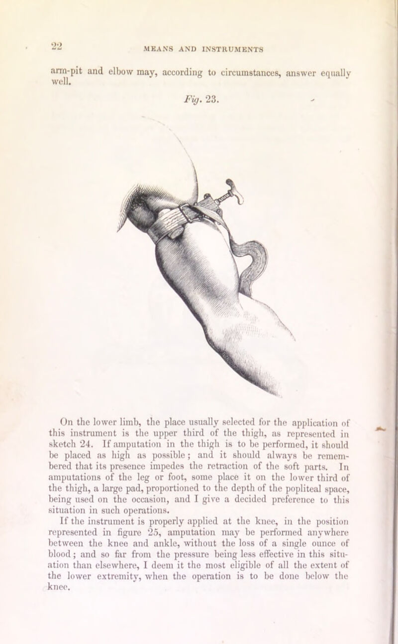 *22 MEANS AND INSTRUMENTS arm-pit and elbow may, according to circumstances, answer equally well. Fig. 23. \ On the lower limb, the place usually selected for the application of this instrument is the upper third of the thigh, as represented in sketch 24. If amputation in the thigh is to be performed, it should be placed as high as possible; and it should always be remem- bered that its presence impedes the retraction of the soft parts. In amputations of the leg or foot, some place it on the lower third of the thigh, a large pad, proportioned to the depth of the popliteal space, being used on the occasion, and I give a decided preference to this situation in such operations. If the instrument is properly applied at the knee, in the position represented in figure 25, amputation may be performed anywhere between the knee and ankle, without the loss of a single ounce of blood; and so far from the pressure being less effective in this situ- ation than elsewhere, I deem it the most eligible of all the extent of the lower extremity, when the operation is to be done below the knee.