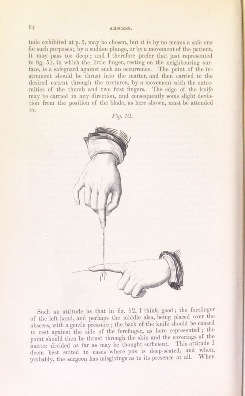 04 tude exhibited at p. 5, may be chosen, but it is by no meivns a safe one for sucli purposes; by a sudden plunge, or by a movement of the patient, it may pass too deep ; and I therefore prefer that just represented in fig. 51, in which the little finger, resting on the neighbouring sur- face, is a safeguard against such an occurrence. The point of the in- strument should be thrust into the matter, and then carried to the desired extent through the textures, by a movement with the extre- mities of the thumb and two first fingers. The edge of the knife may be carried in any direction, and consequently some slight devia- tion from the position of the blade, as here shown, must be attended to. Fi/j. 52. Such an attitude as that in fig. 52, I think good ; the forefinger of the left hand, and perhaps the middle also, being placed over the abscess, with a gentle pressure ; the back of the knife should be caused to rest against the side of the forefinger, as here represented ; the point should then be thrust through the skin and the coverings ot the matter divided as far as may be thought sufficient. This attitude I deem best suited to cases where pus is deep-seated, and when, probably, the surgeon has misgivings as to its presence at all. W hen