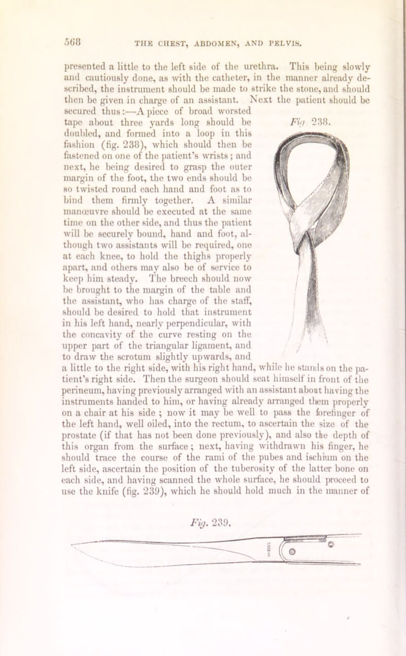 .500 Fit 238. presented a little to the left side of the urethra. This being slowly and cautiously done, as with the catheter, in the manner already de- scribed, the instrument should be made to strike the stone, and should then be given in charge of an assistant. Next the patient should be secured thus:—A piece of broad worsted tape about three yards long should be doubled, and formed into a loop in this fashion (fig. 238), which should then be fastened on one of the patient’s wrists ; and next, he being desired to grasp the outer margin of the foot, the two ends should be so twisted round each hand and foot as to bind them firmly together. A similar manoeuvre should be executed at the same time on the other side, and thus the patient will be securely bound, hand and foot, al- though two assistants will be required, one at each knee, to hold the thighs properly apart, and others may also be of service to keep him steady. The breech should now be brought to the margin of the table and the assistant, who has charge of the staff, should be desired to hold that instrument in his left hand, nearly perpendicular, with the concavity of the curve resting on the upper part of the triangular ligament, and to draw the scrotum slightly upwards, and a little to the right side, with his right hand, while he stands on the pa- tient’s right side. Then the surgeon should seat himself in front of the perineum, having previously arranged with an assistant about having the instruments handed to him, or having already arranged them properly on a chair at his side ; now it may be well to pass the forefinger of the left hand, well oiled, into the rectum, to ascertain the size of the prostate (if that has not been done previously), and also the depth of this organ from the surface; next, having withdrawn his finger, he should trace the course of the rami of the pubes and ischium on the left side, ascertain the position of the tuberosity of the latter bone on each side, and having scanned the whole surface, he should proceed to use the knife (fig. 239), which he should hold much in the manner of