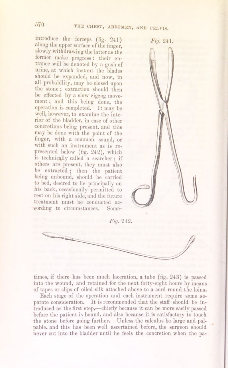 introduce the forceps (fig. 241) along the upper surface of the finger, slowly withdrawing the latter as the former make progress: their en- trance will be denoted by a gush of urine, at which instant the blades should be expanded, and now, in all probability, may be closed upon the stone; extraction should then be effected by a slow zigzag move- ment ; and this being done, the operation is completed. It may be well, however, to examine the inte- rior of the bladder, in case of other concretions being present, and this may be done with the point of the finger, with a common sound, or with such an instrument as is re- presented below (fig. 242), which is technically called a searcher; if others are present, they must also be extracted ; then the patient being unbound, should be carried to bed, desired to lie principally on his back, occasionally permitted to rest on his right side, and the future treatment must be conducted ac- cording to circumstances. Some- Fig. 241. Fig. 242. times, if there has been much laceration, a tube (fig. 243) is passed into the wound, and retained for the next forty-eight hours by means of tapes or slips of oiled silk attached above to a cord round the loins. Each stfige of the operation and each instrument require some se- parate consideration. It is recommended that the staff should be in- troduced as the first step,—chiefly because it can be more easily passed before the patient is bound, and also because it is satisfactory to touch the stone before going further. Unless the calculus be large and pal- pable, and this has been well ascertained before, the surgeon should never cut into the bladder until he feels the concretion when the pa-