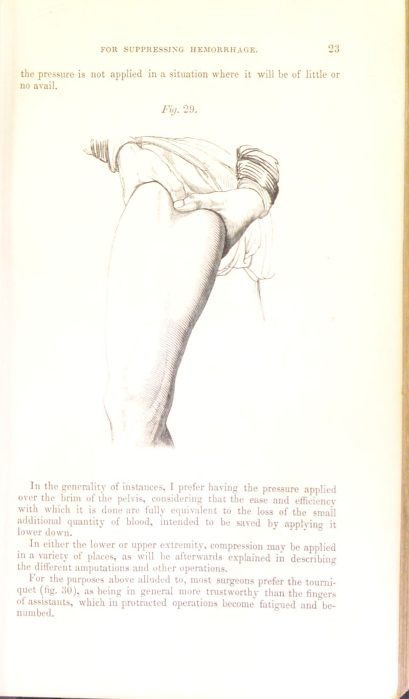 the pressure is not applied in a situation where it will be of little or no avail. /•V 29. In the penenility of instances, I prefer having,' the pressure applied over the brim of the pelvis, considering that the ease and efficiency with which it is done are fully eciuivalent to the loss of the small additional (]uantity of blood, intended to be saved by applying it lower down. In either the lower or upper e.xtremity, compression may be applied in a variety of places, as will be afterwards e.xplained in describing the dirt'erent amputations and other openttions. For the purpo.ses above alluded to, most surgeons prefer the toumi- quet (tig. 30), as being in general more trustworthy than the fingers of assisUints, which in protracted operations become fatigued and be- numbed.