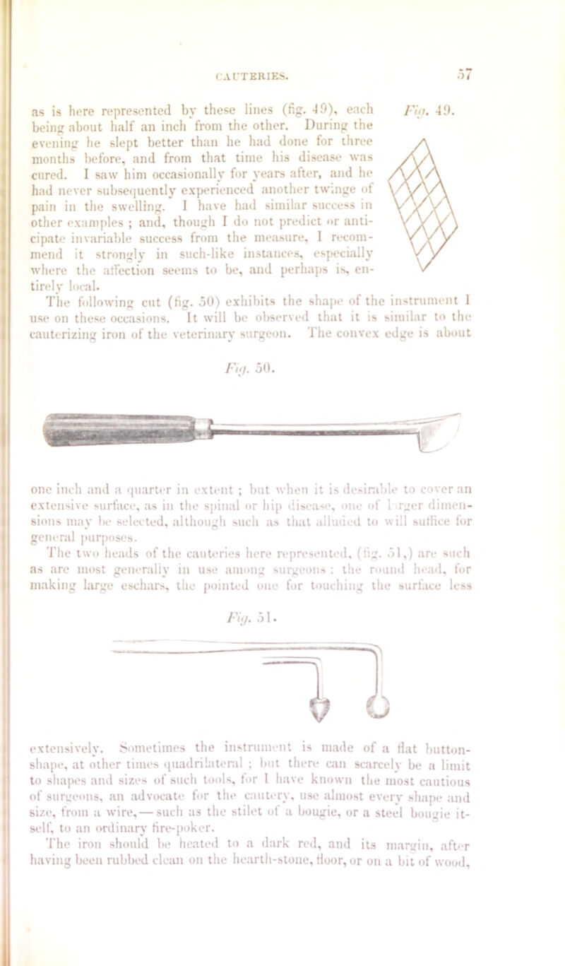 CAL'TERIES. O/ as is here represented by these lines (fig. 49), each Piiu 49. being about half an inch from the other. During the evening he slept better than he had done for three months before, and from that time his disease was cured. I saw him occasionally for years after, and he had never subsequently experienced another twinge of pain in the swelling. I have had similar success in other examples ; and, though I do not predict or anti- cipate invariable success from the measure, 1 ri-com- mend it strongly in such-like instances, especially where the atfection seems to be, and perhaps is, en- tirely local. The following cut (fig. .50) exhibits the shape of the instrument 1 use on these occasions. It will be observed that it is similar to the cauterizing iron of the veterinary surgeon. The convex edge is about /•’(</. ot). one inch and a (piarter in extent ; but when it is desirable to cover an extensive surface, as in the spinal or hip i!iseas(‘, one of 1 rger dimen- sions may be selected, although such as that alluded to will sutfice for general purposes. The two heads of the cauteries here represented, (fig. .51,) are such ns are most generally in u.se among surgeons : the nminl head, for milking large eschars, the pointed one for touching the surfiice less FiiJ. ol. extensively. Sometimes the instrument is m.ade of a fiat button- shape, at other times quadrilateral ; but there ciin scarcely be n limit to shapes and sizes of such tools, tor I have known the most cautious of surgeons, an advocate for the ciiutery, use almost every shape and size, from a wire, — such as the stilet of a bougie, or a steel bougie it- self, to an ordinary fire-poker. The iron should be heated to a dark red, and its margin, after having been rubbed cleiin on the hearth-stone, fioor, or on a bit of wood.