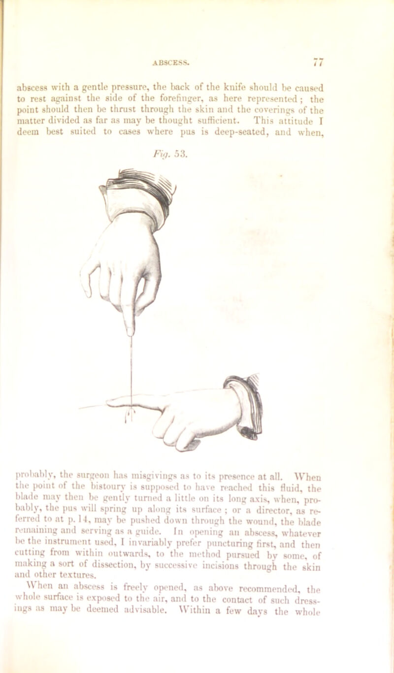 abscess with a gentle pressure, the Ijack of the knife should be caused to rest against the side of the forefinger, as here represented; the point should then be thrust through the skin and the coverings of the matter divided as fiir as may be thought sufficient. This attitude I deem best suited to cases where pus is deep-seated, and when. Fi;i. 5.3. l>rol)iibly, the surgeon has misgivings as to its presence at all. ^\'hen the point of the bistoury is supposed to have reached this fluid, the blade may then be gently turned a little on its long axis, when, pro- bably, the pus will spring up along its surface ; or a director, as rt*- ferred to at p. U, may be pushed down through the wound, the blade remaining and serving as a guide. I n opening an abscess, whatever be the instrument used, I invarLibly prefer puncturing first, and then cutting from within outwards, to the method pursued bv some, of making a sort of dissection, by successive incisions through the skin and other textures. \\ hen an abscess is freely opened, as alwve ri'commended, the whole surface is exposed to the air, and to the contact of such dress- ings :i8 may be deemed advisable. Within a few days the whole