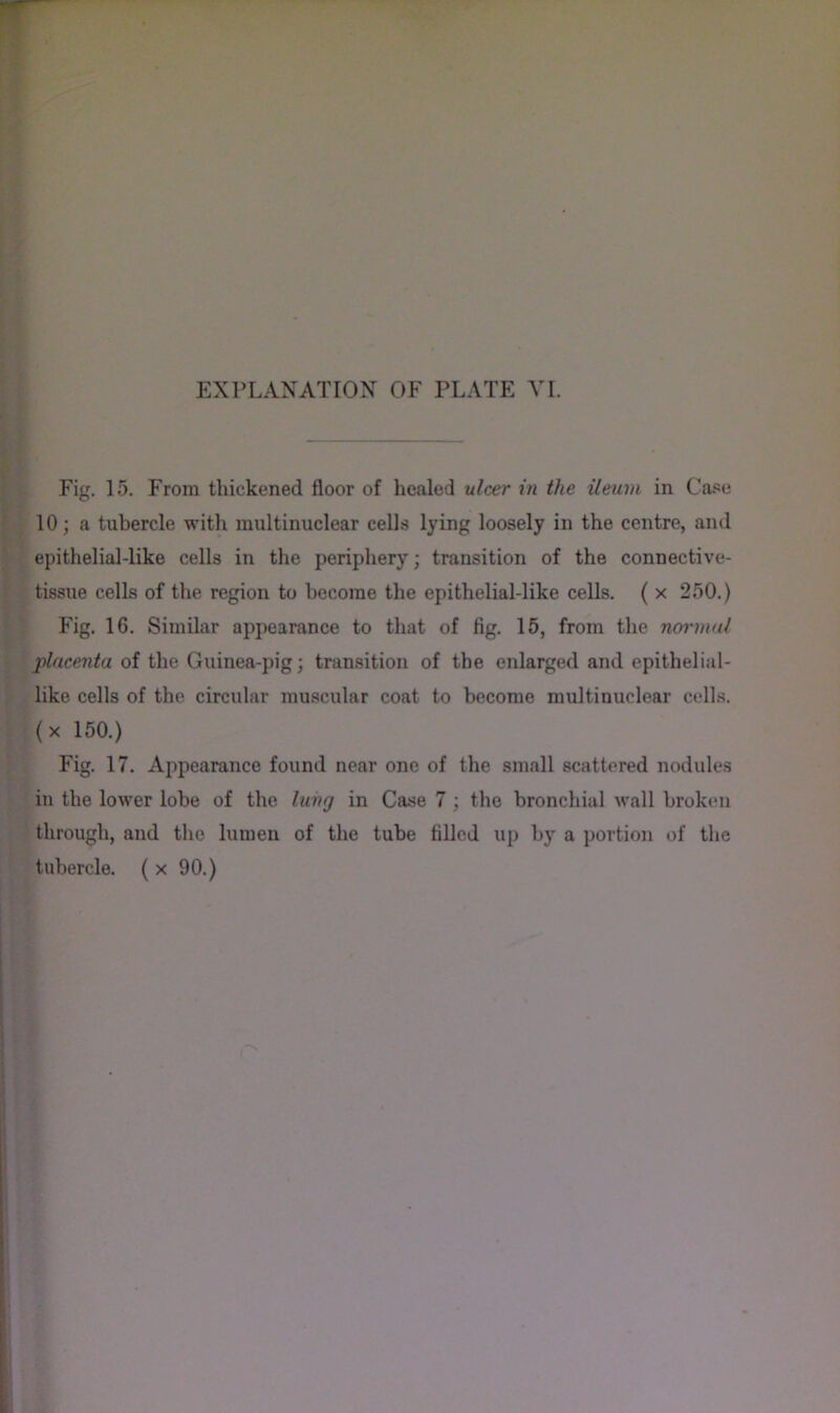 Fig. 15. From thickened floor of healed ulcer in the ileum in Ca.'se 10; a tubercle with multinuclear cells lying loosely in the centre, and epithelial-like cells in the periphery; transition of the connective- tissue cells of the region to become the epithelial-like cells. ( x 250.) Fig. 16. Similar appearance to that of fig. 15, from the normal placenta of the Guinea-pig; transition of the enlarged and epithelial- like cells of the circular muscular coat to become multinuclear cells, (x 150.) Fig. 17. Appearance found near one of the small scattered nodules in the lower lobe of the lung in Case 7; the bronchial wall broken through, and the lumen of the tube filled up by a portion of the