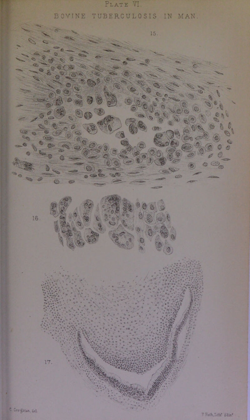 Plate VI. BOVINE TUBERCULOSIS IN MAN. Cr«^JnUr., d?! V HulH.!.